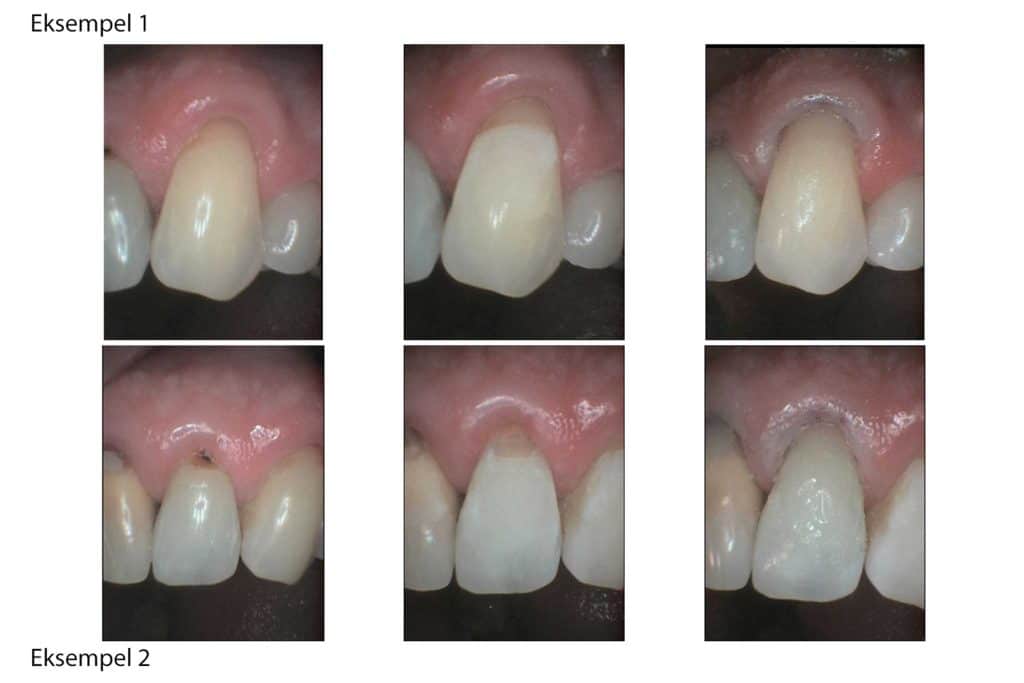 Galleri: På Kolbotn Tannklinikk vises arbeidsprosessen ved reparasjon av pusseskader – tannlege i Kolbotn, Vinterbro og Sofiemyr.