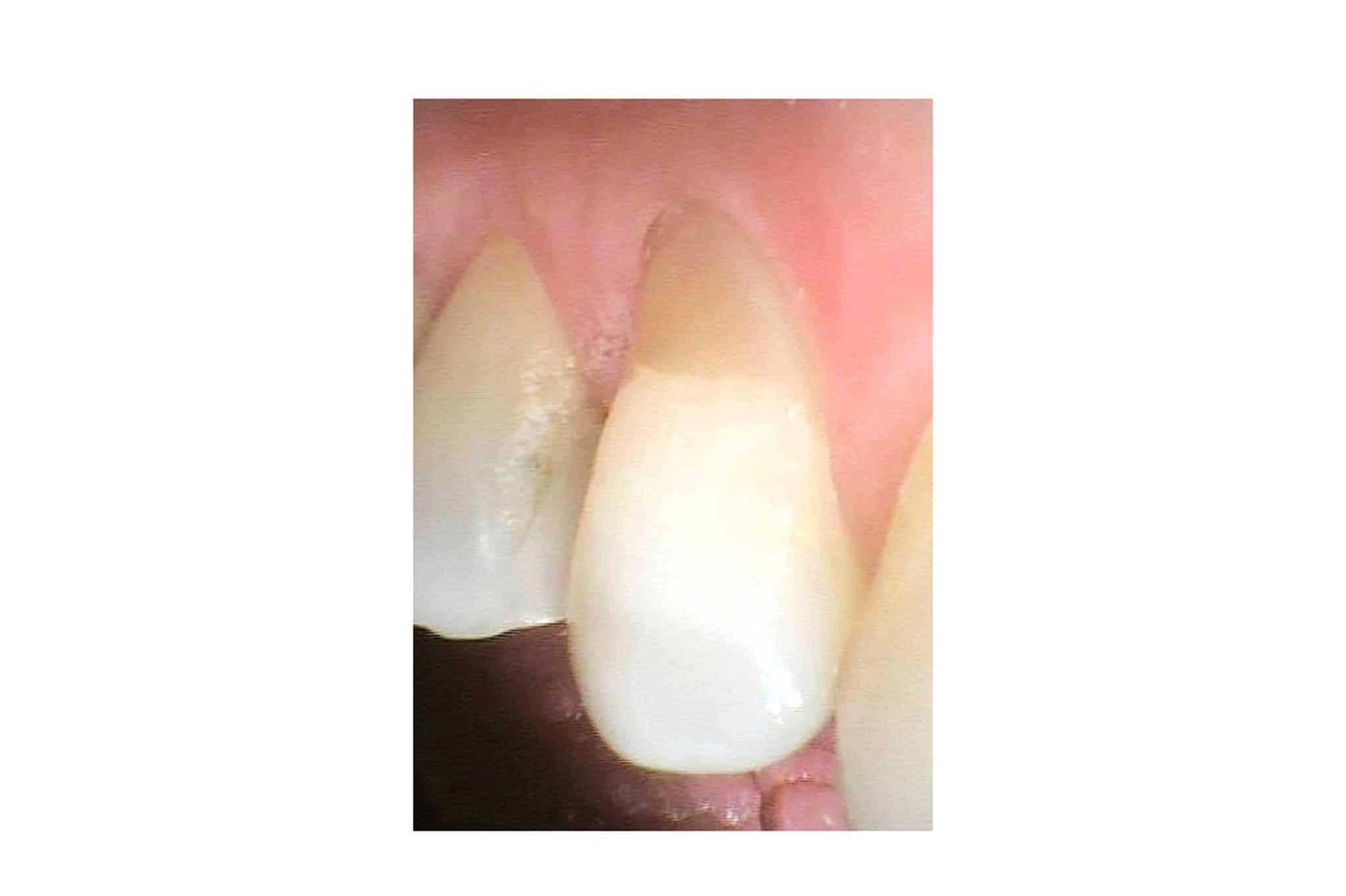 Tannlegene ved Kolbotn Tannklinikk behandler pusseskader på hjørnetenner med tannfarget fylling – trygg behandling i Kolbotn, Vinterbro og Holmlia.