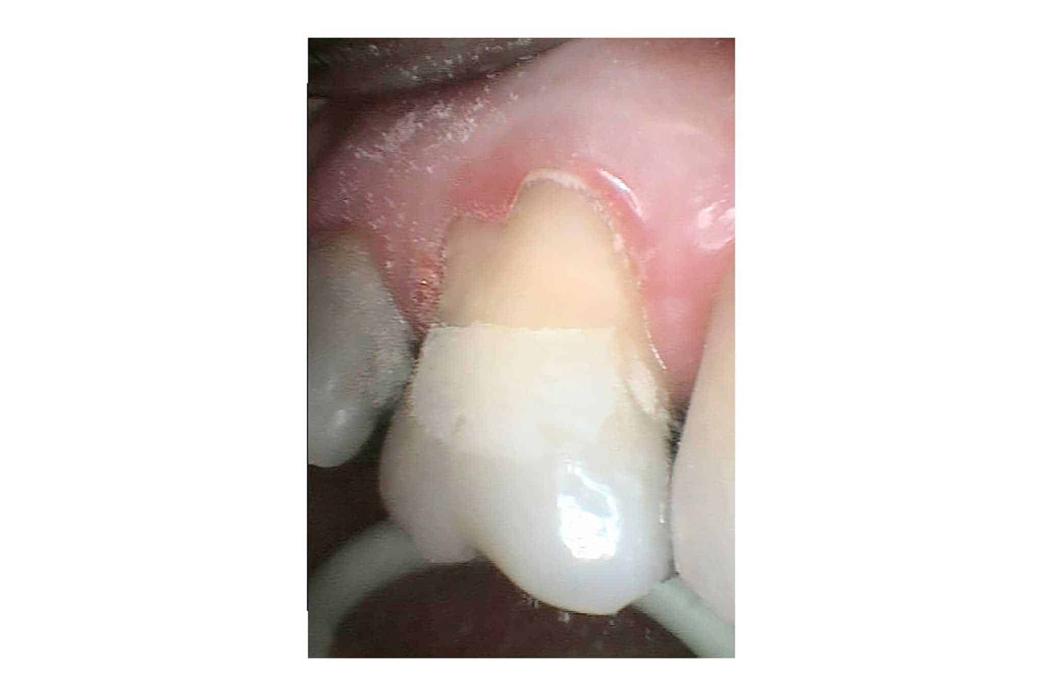 Hos Kolbotn Tannklinikk behandles jeksler med pusseskader ved hjelp av fyllingsmateriale – tannlege i Kolbotn, Myrvoll og Follo.