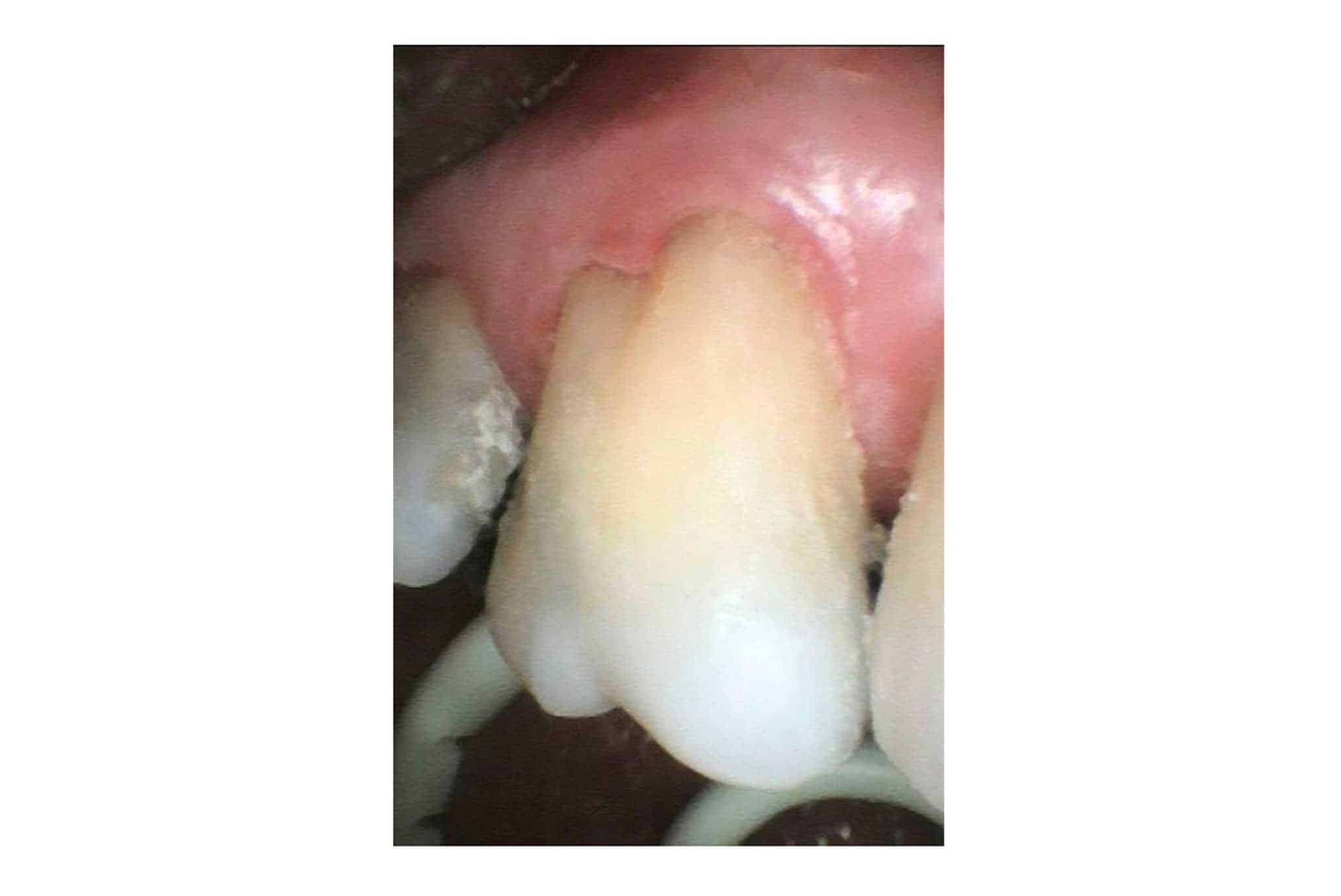 Jeksel med pusseskade behandlet med tannfarget fyllingsmateriale.