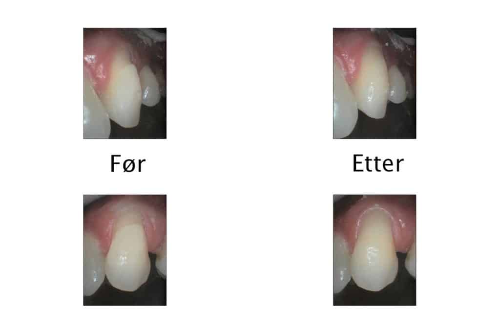 Galleri: Tannlegene ved Kolbotn Tannklinikk reparerer pusseskader med fylling – Kolbotn, Myrvoll og Nordstrand.