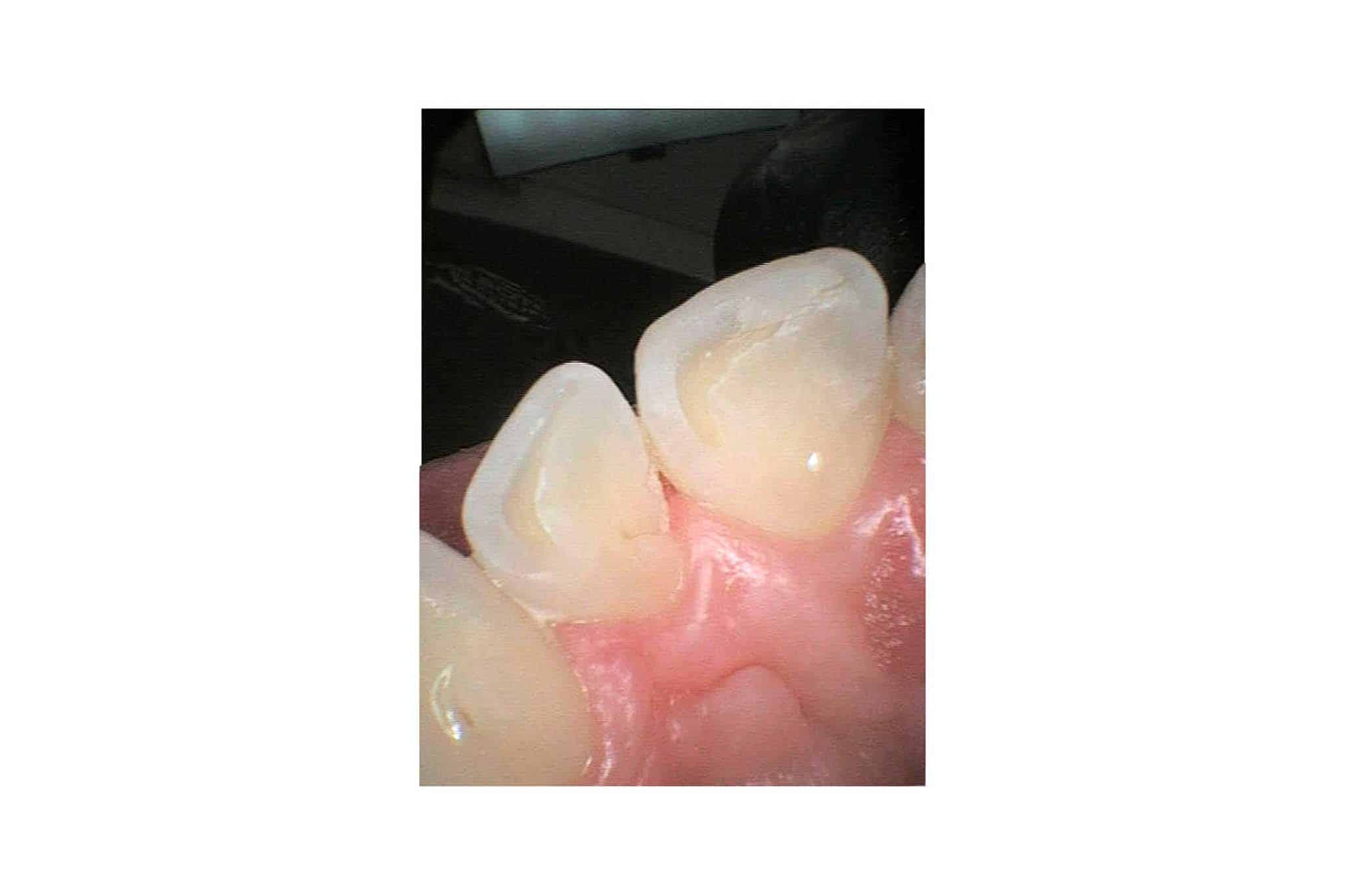 Før- og etterbilde: Hos Kolbotn Tannklinikk behandles fortenner med erosjonsskader med tannfarget fylling – Kolbotn, Oppegård, Follo og Hauketo.