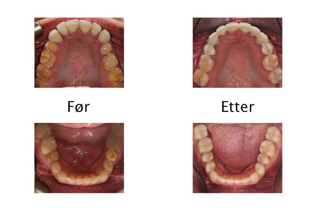 Hos Kolbotn Tannklinikk behandles syreskader med varige løsninger – tannklinikk i Kolbotn, Sofiemyr, Oppegård og Follo.