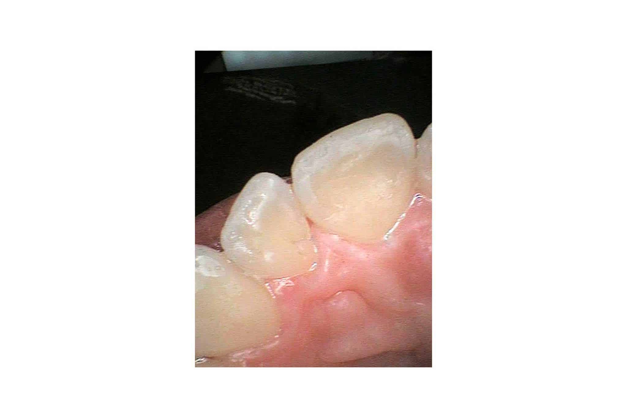 Før- og etterbilde: Hos Kolbotn Tannklinikk behandles fortenner med erosjonsskader med tannfarget fylling – Kolbotn, Oppegård, Follo og Hauketo.