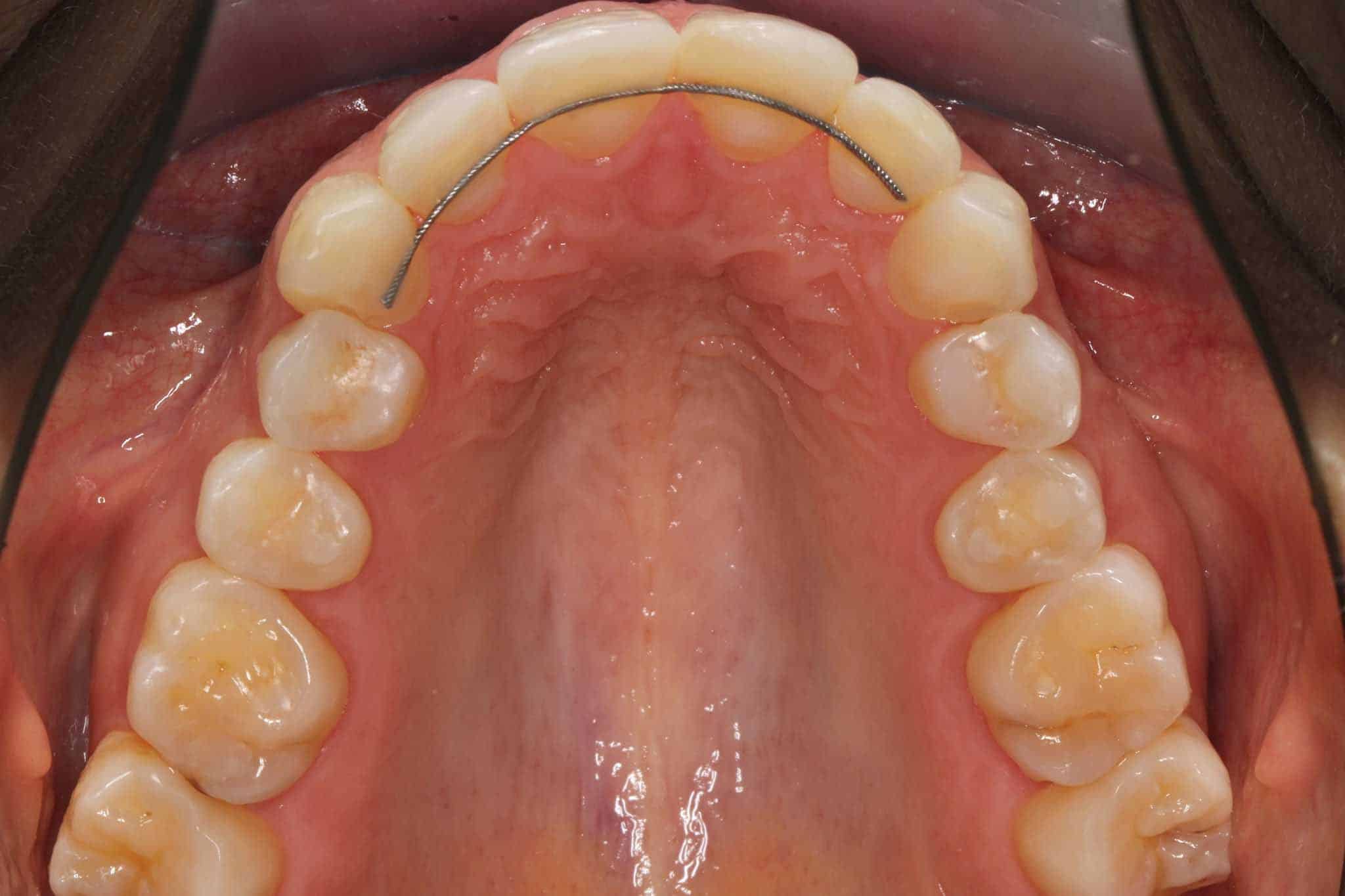 Før- og etterbilde: Ved Kolbotn Tannklinikk gjenoppbygges overkjevetenner med tannfarget fyllingsmateriale – Kolbotn, Nordstrand, Myrvoll og Sofiemyr.