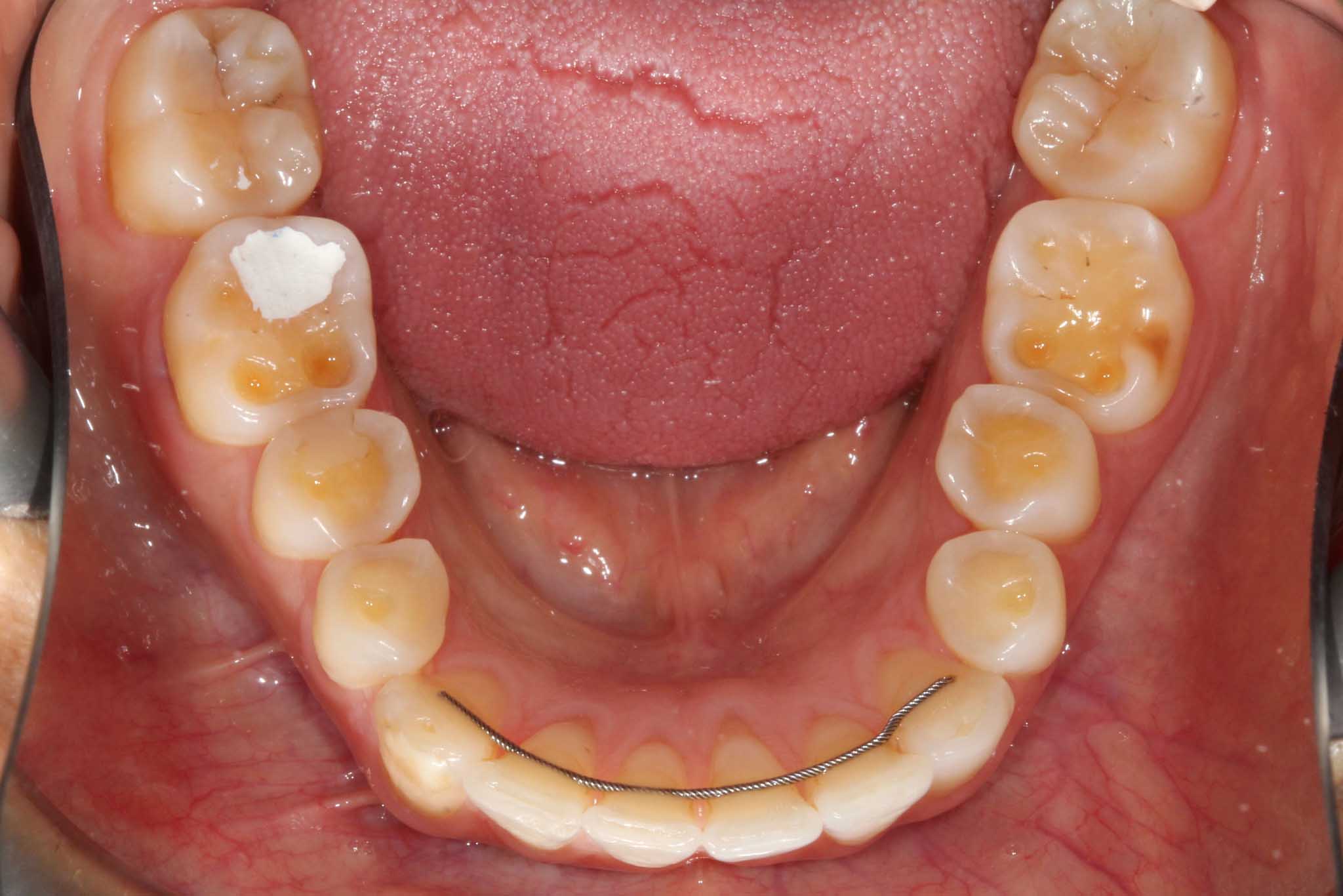 Underkjevetenner med syreskader behandlet profesjonelt.