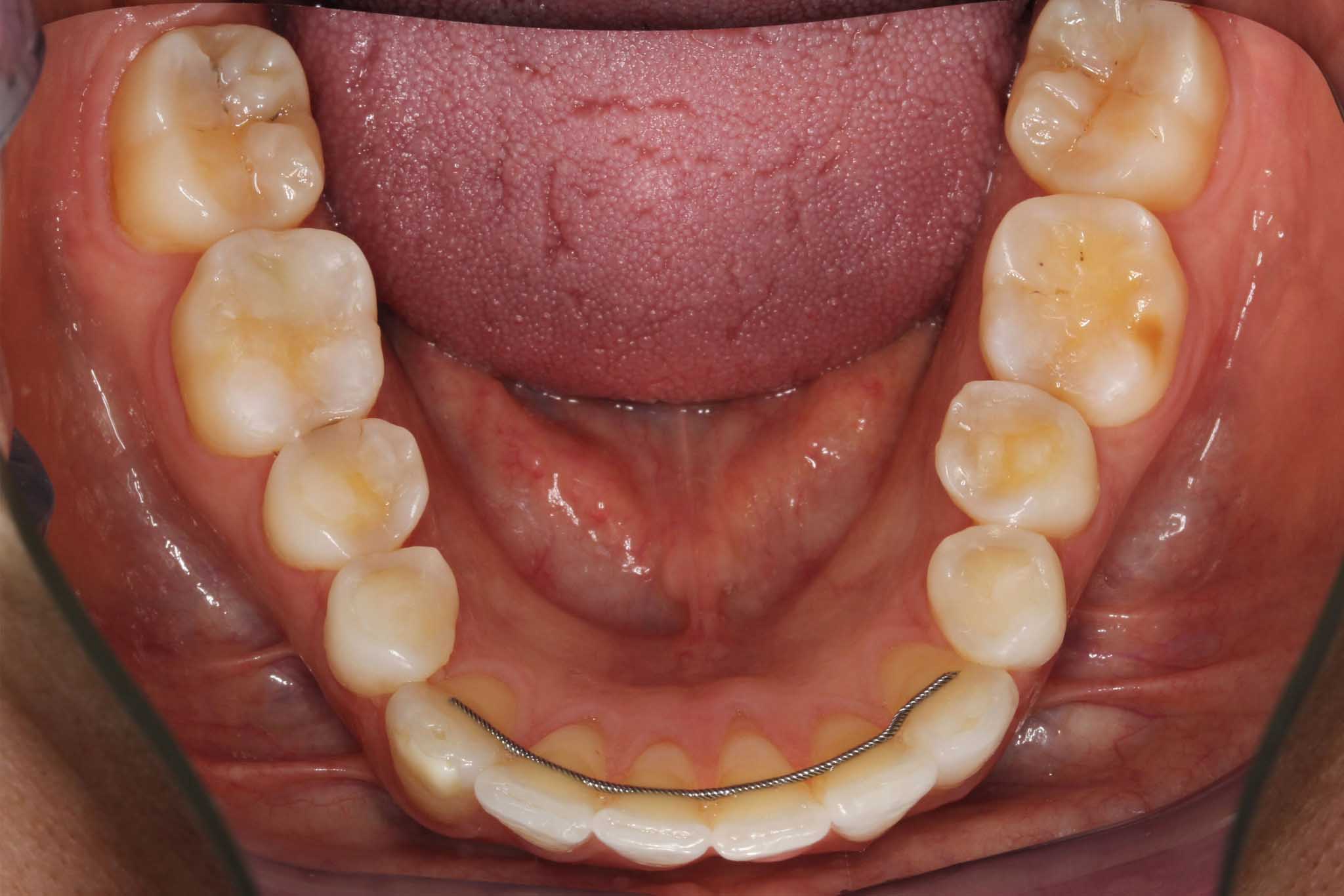 Før- og etterbilde: Tannleger på Kolbotn Tannklinikk behandler underkjeve med syreskader – Kolbotn, Vinterbro, Greverud og Holmlia.