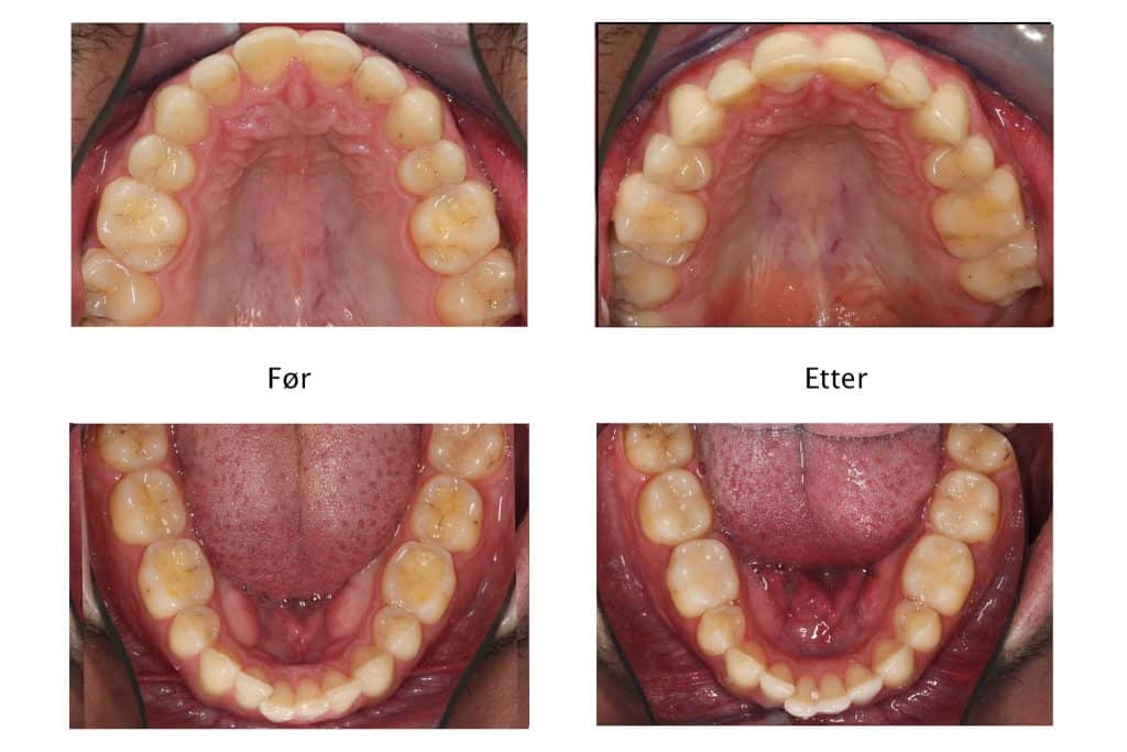 Galleri: Hos Kolbotn Tannklinikk behandles syreskader med tannfarget fyllingsmateriale – pasienter fra Kolbotn, Follo og Oppegård.