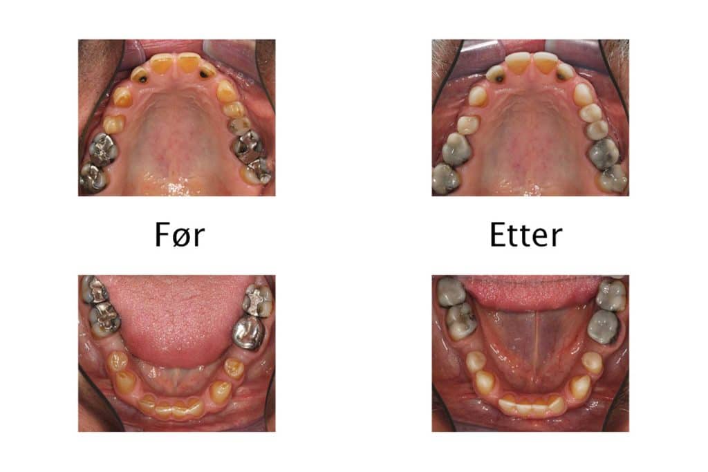 Tannleger ved Kolbotn Tannklinikk gjenoppbygger tenner med syreskader – Kolbotn, Greverud, Follo og Nordstrand.