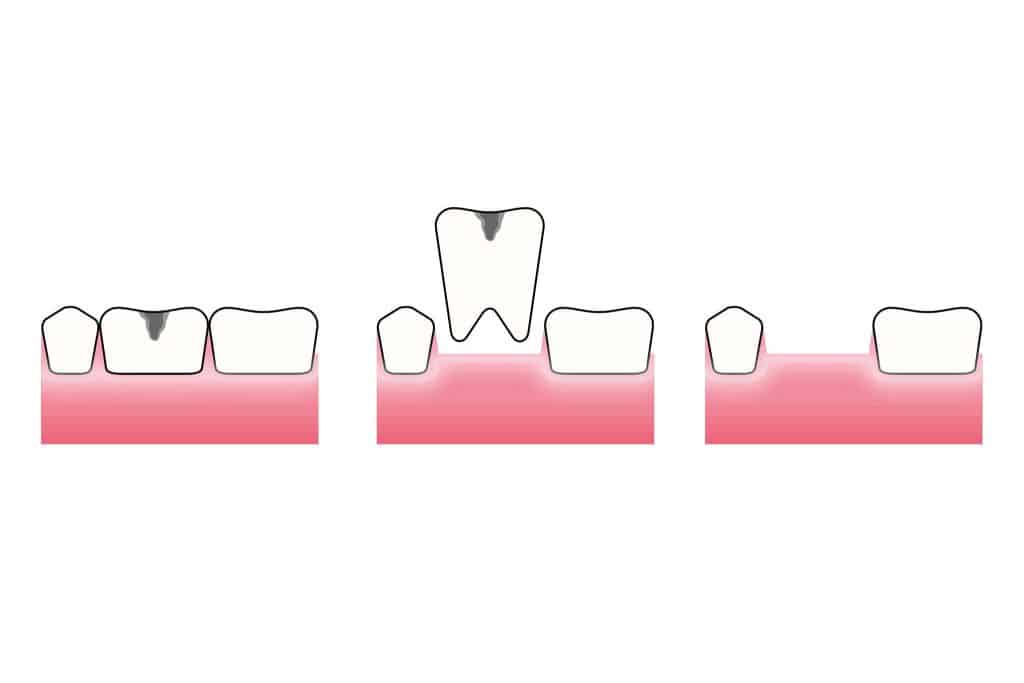 Hos Kolbotn Tannklinikk illustreres trygg tanntrekking av en skadet tann – behandling for pasienter i Kolbotn, Follo og Oppegård.