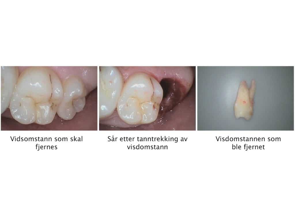 Galleri: Ved Kolbotn Tannklinikk fjernes visdomstann i overkjeven – Kolbotn, Sofiemyr, Greverud og Nordstrand.