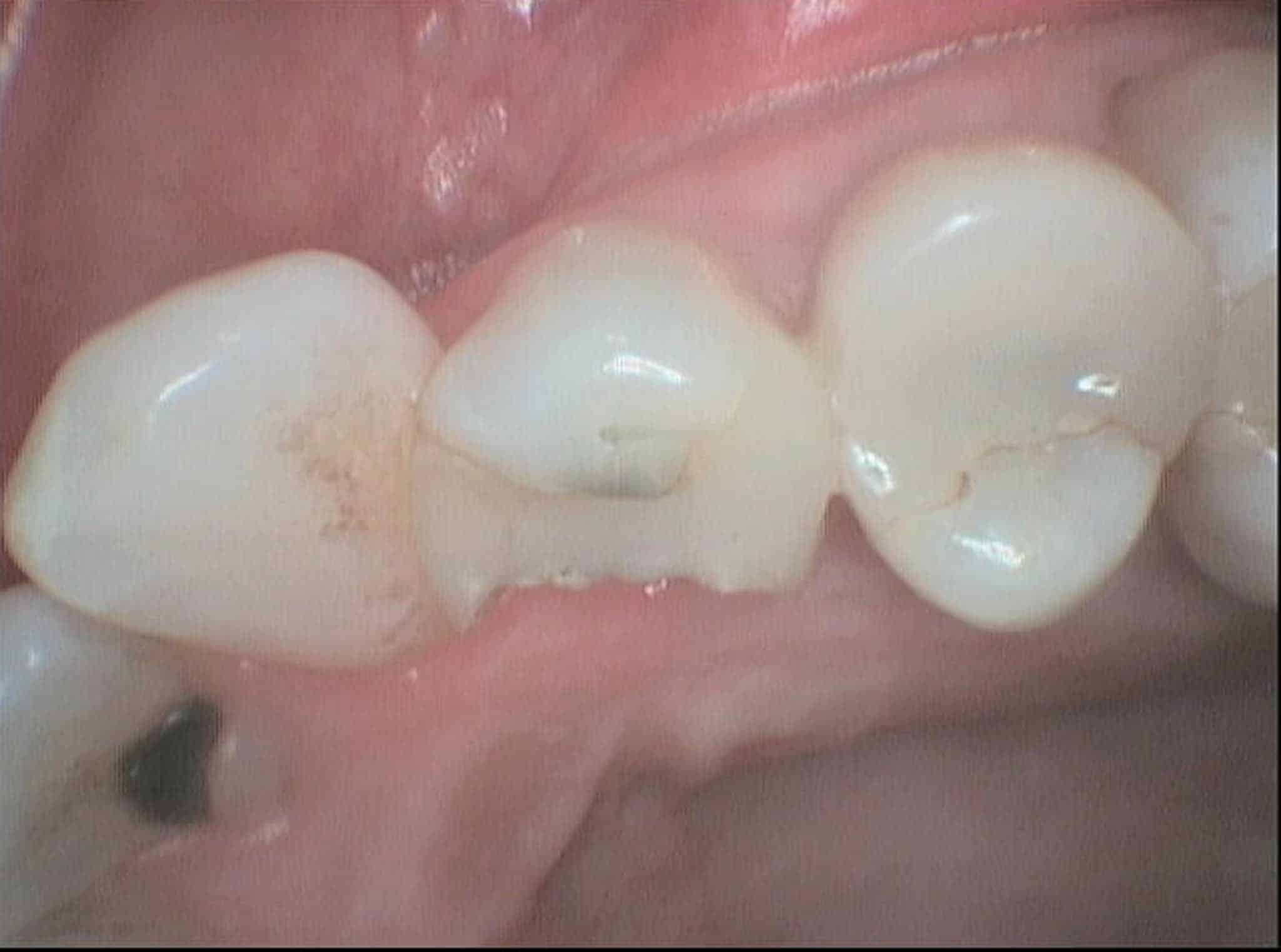Før- og etterbilde: Hos Kolbotn Tannklinikk utfører tannlegene trygg tanntrekking – Kolbotn, Follo, Hauketo og Oppegård.