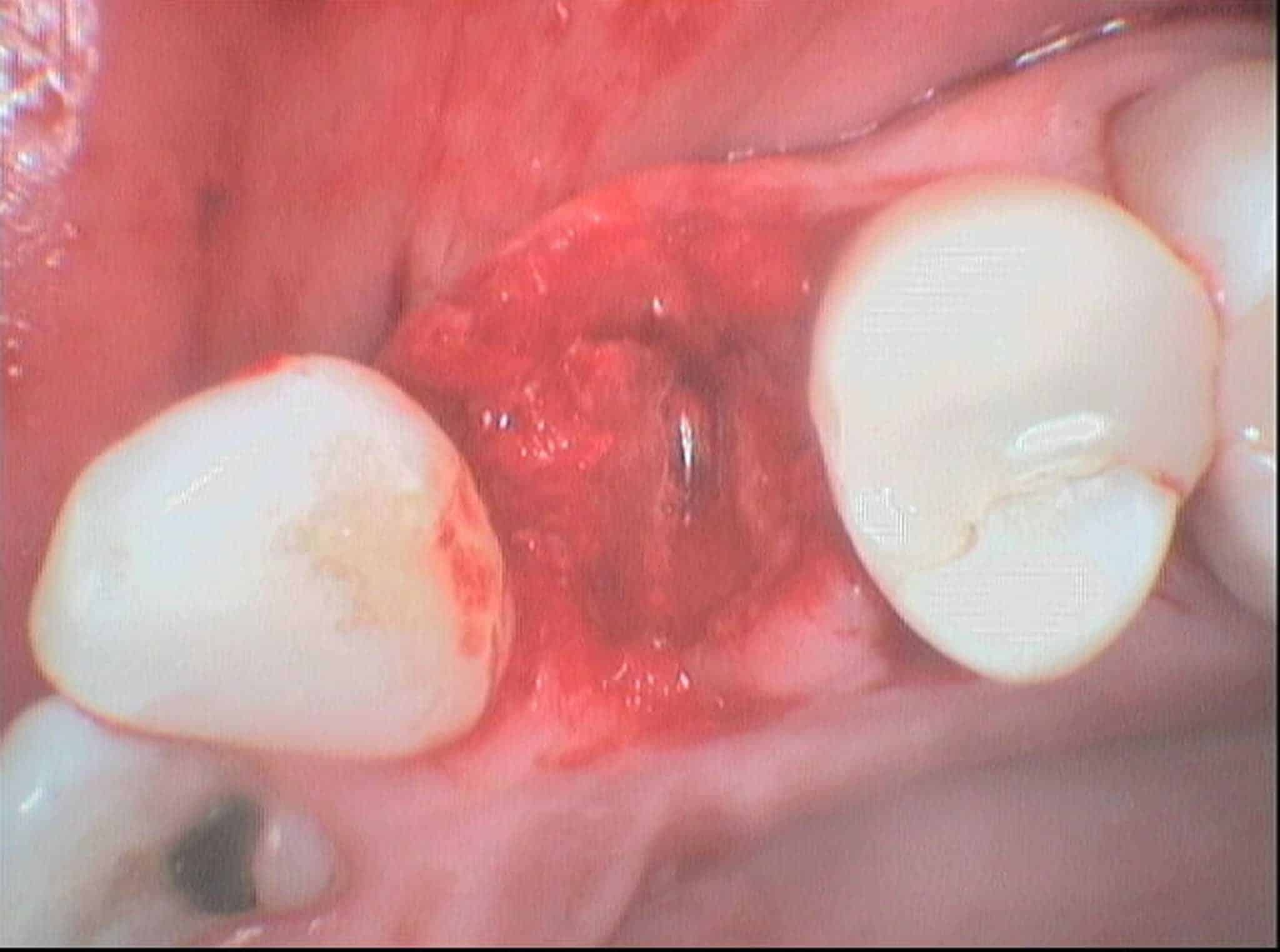 Før- og etterbilde: Hos Kolbotn Tannklinikk utfører tannlegene trygg tanntrekking – Kolbotn, Follo, Hauketo og Oppegård.