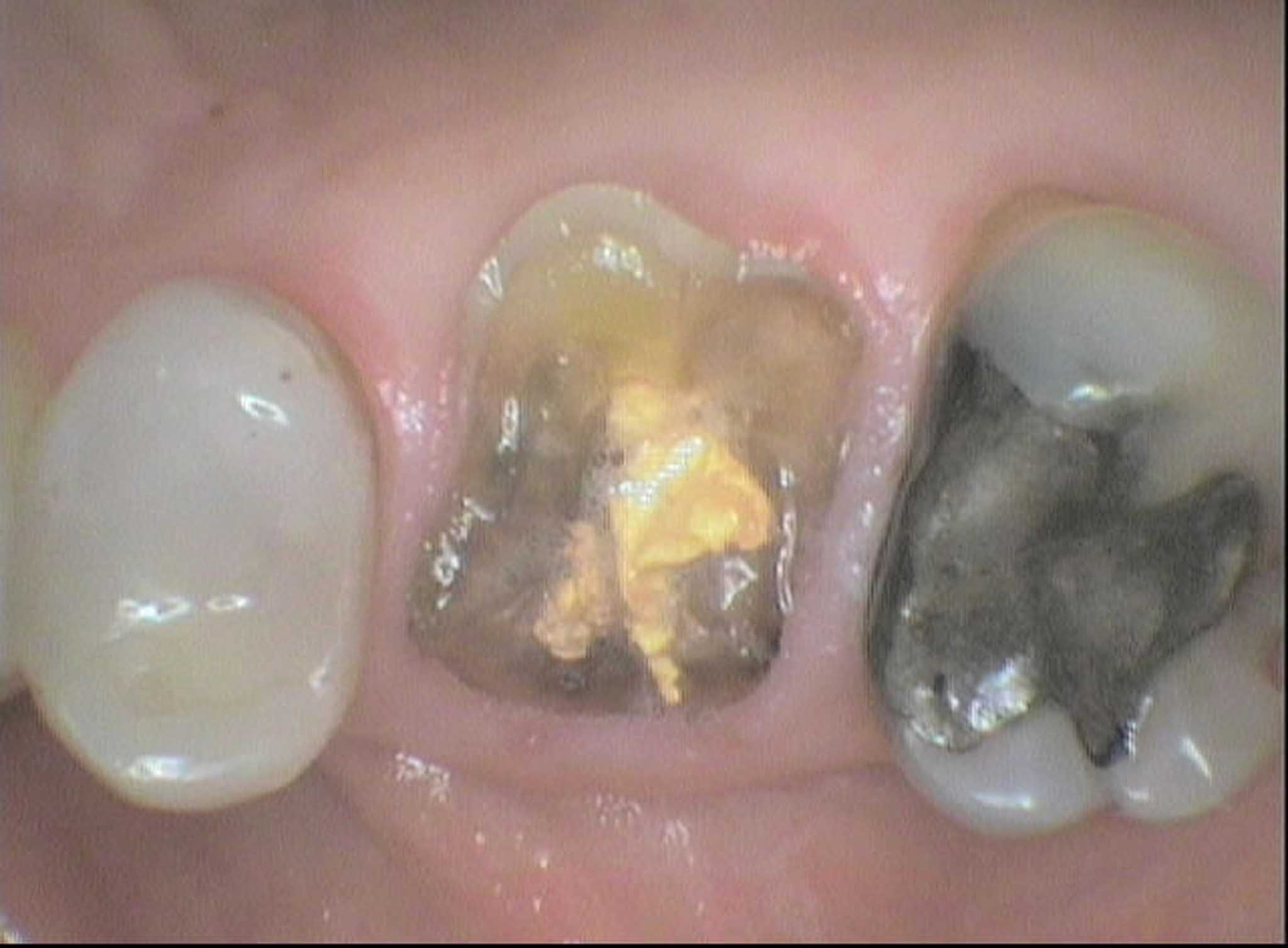 Før- og etterbilde: Ved Kolbotn Tannklinikk utføres kirurgisk tanntrekking på en trygg og skånsom måte – Kolbotn, Nordstrand, Myrvoll og Sofiemyr.