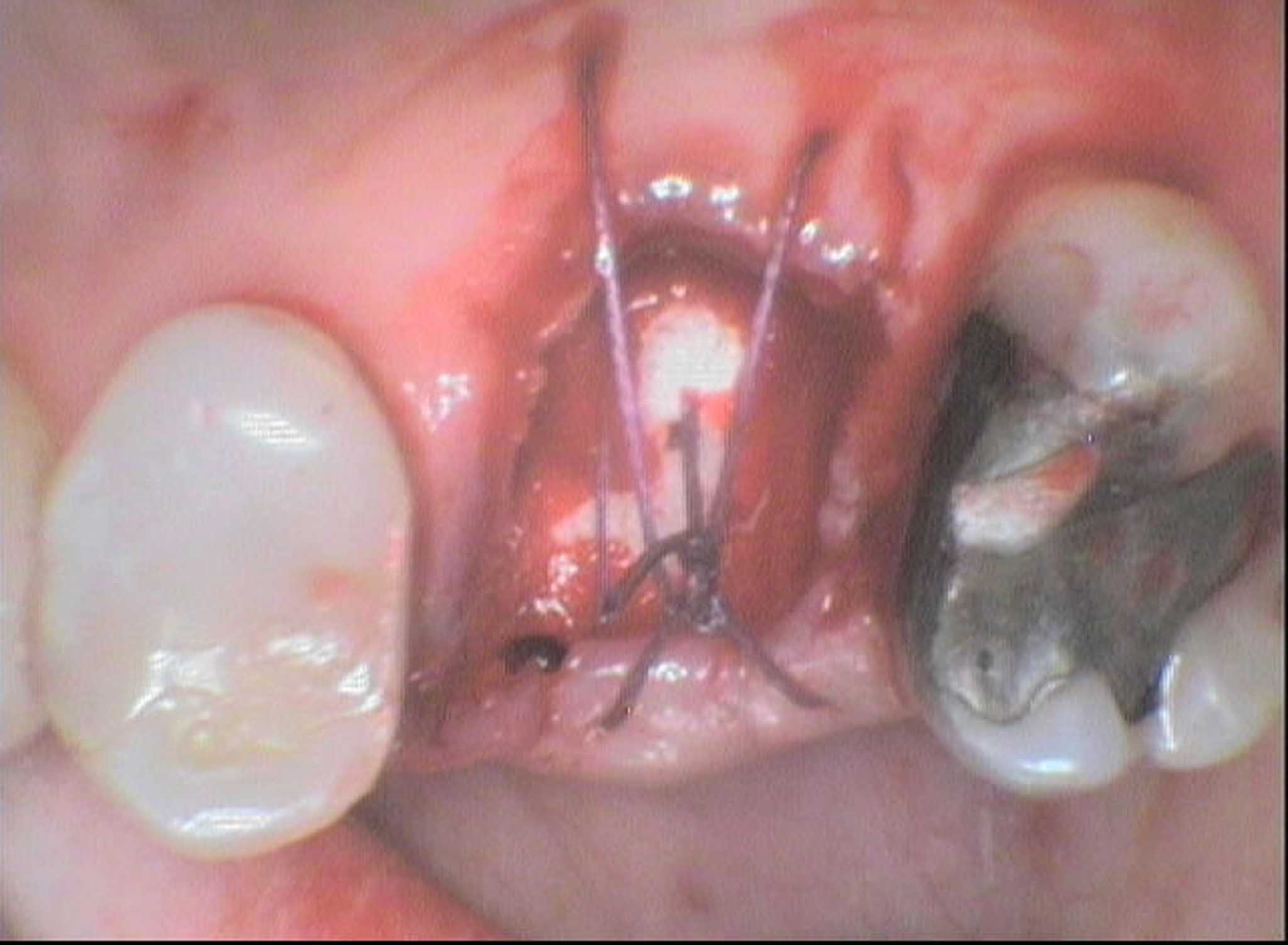 Bildet viser en kirurgisk tanntrekking.