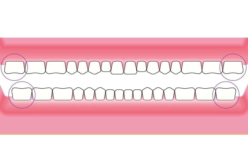 Tannlegene på Kolbotn Tannklinikk viser posisjon av visdomstenner i tannsett – Kolbotn, Vinterbro, Sofiemyr og Holmlia.