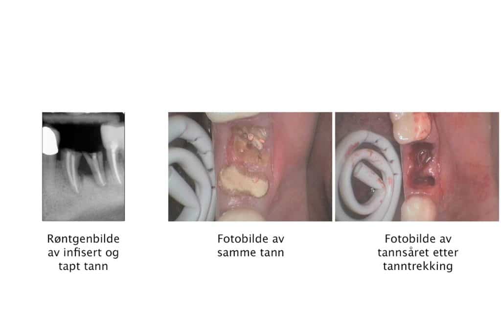 Galleri: Tannleger på Kolbotn Tannklinikk viser prosess ved tanntrekking – Kolbotn, Oppegård og Follo.