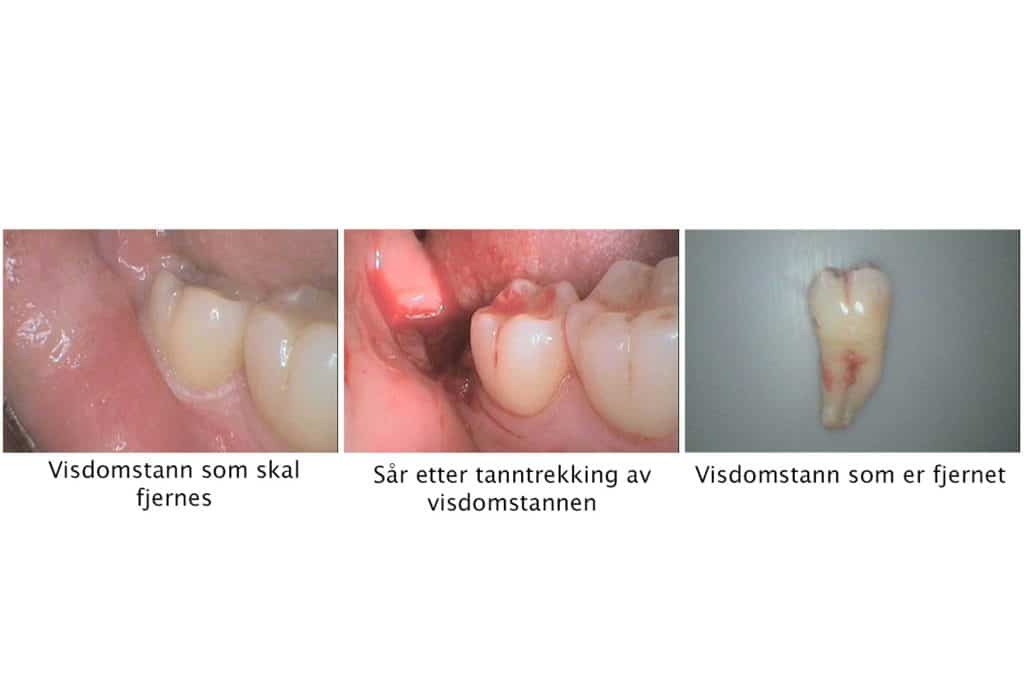 Galleri: Hos Kolbotn Tannklinikk fjernes visdomstann i underkjeven – Kolbotn, Vinterbro, Holmlia og Follo.