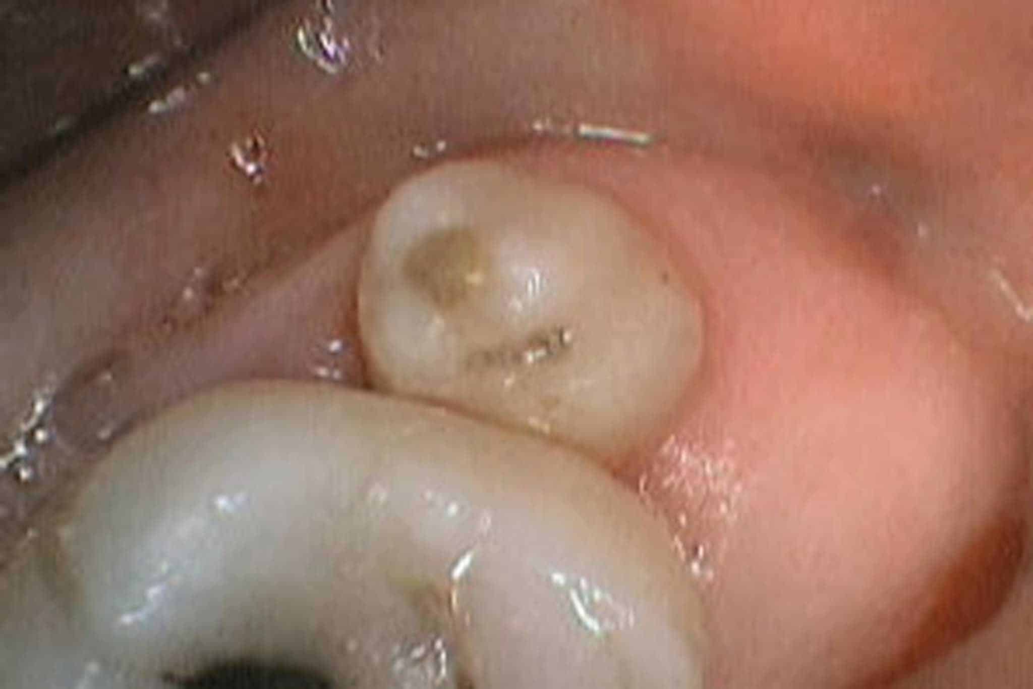 Før- og etterbilde: Hos Kolbotn Tannklinikk fjernes visdomstann trygt og skånsomt – behandling i Kolbotn, Follo, Oppegård og Myrvoll.