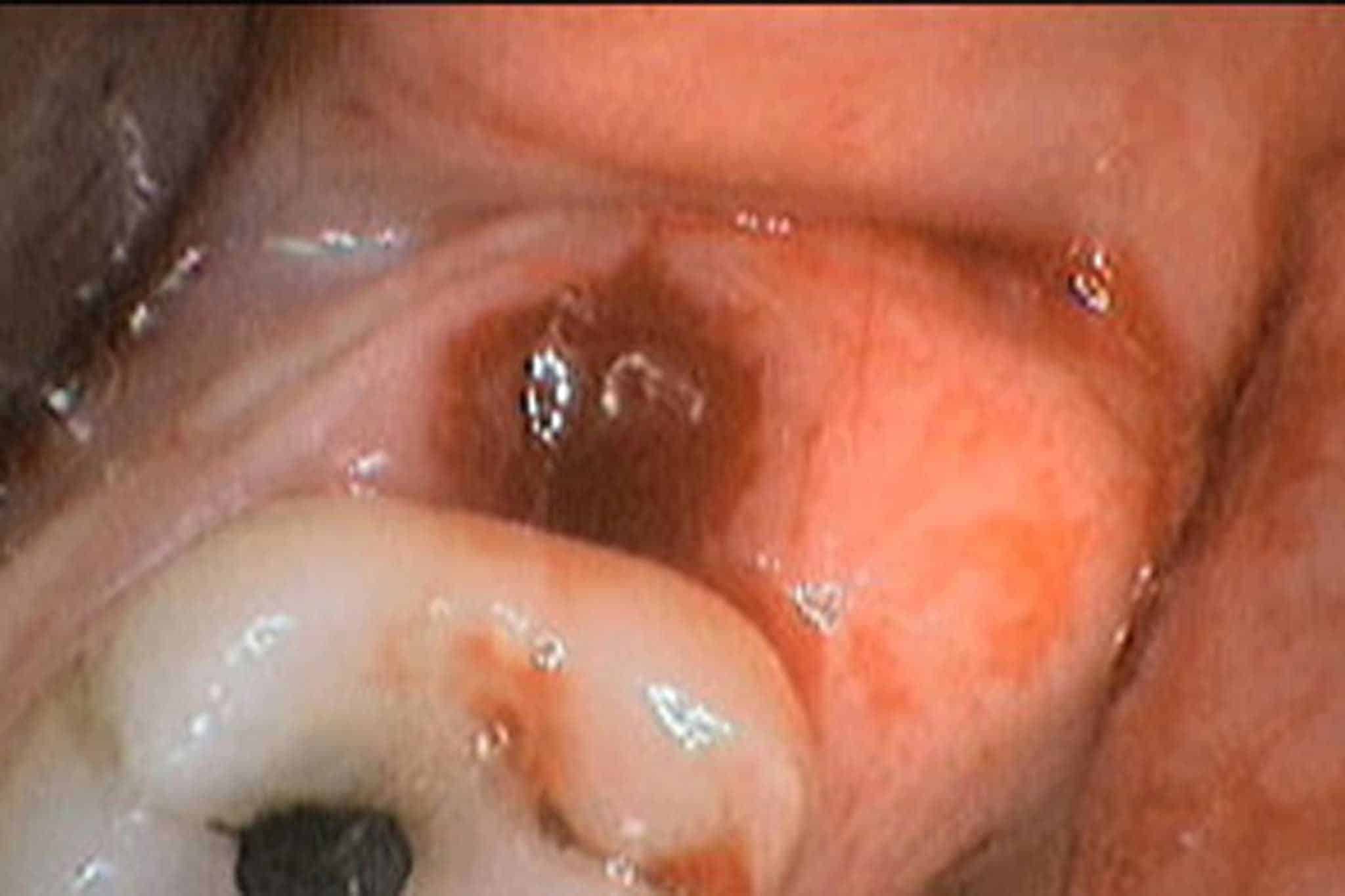 Før- og etterbilde: Hos Kolbotn Tannklinikk fjernes visdomstann trygt og skånsomt – behandling i Kolbotn, Follo, Oppegård og Myrvoll.