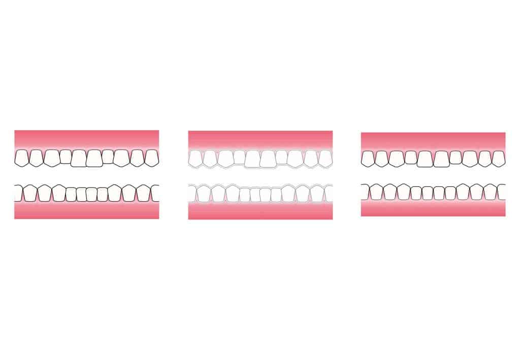 Ved Kolbotn Tannklinikk vises hvordan Invisalign-skinner gradvis flytter tennene – trygg og usynlig behandling i Kolbotn, Follo, Vinterbro og Nordstrand.