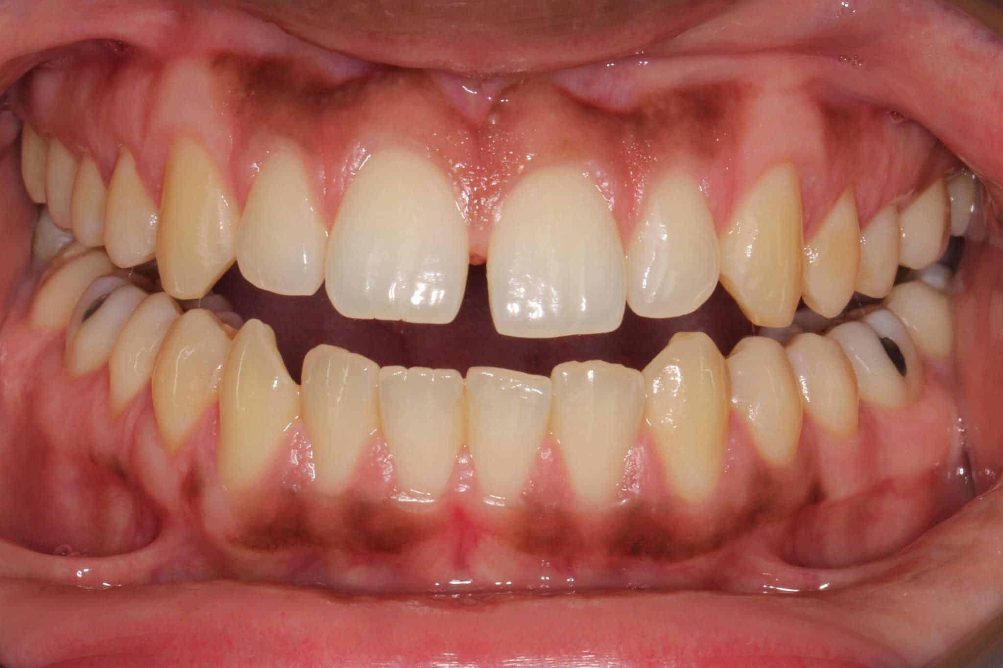 Før- og etterbilde: Hos Kolbotn Tannklinikk rettes tennene med Invisalign – trygg korttidstannregulering i Kolbotn, Follo, Vinterbro og Sofiemyr.