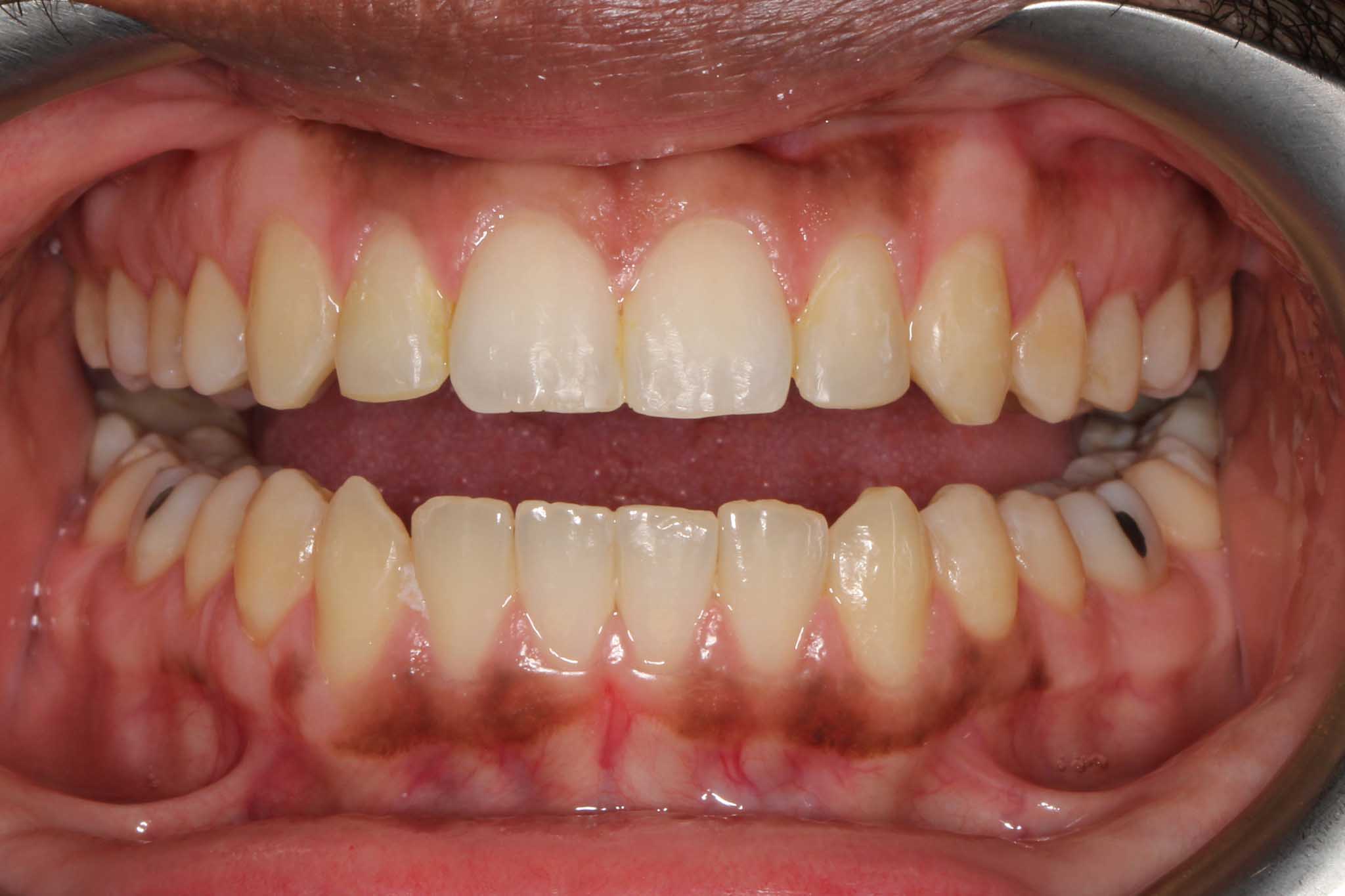 Før- og etterbilde: Hos Kolbotn Tannklinikk rettes tennene med Invisalign – trygg korttidstannregulering i Kolbotn, Follo, Vinterbro og Sofiemyr.