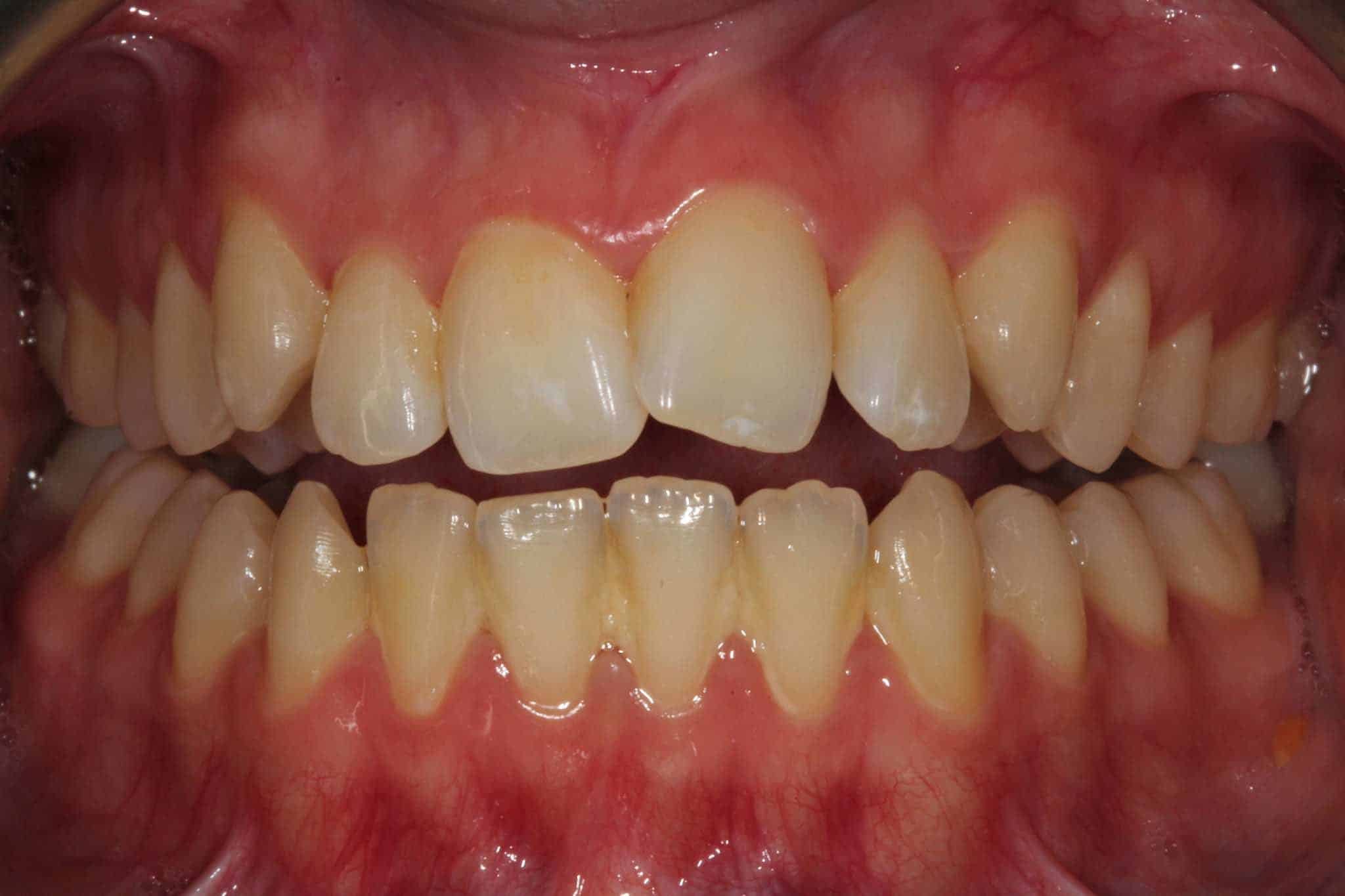 Før- og etterbilde: Tannlegene ved Kolbotn Tannklinikk bruker Inman Aligner for å korrigere fortenner – pasienter i Kolbotn, Oppegård, Follo og Holmlia.