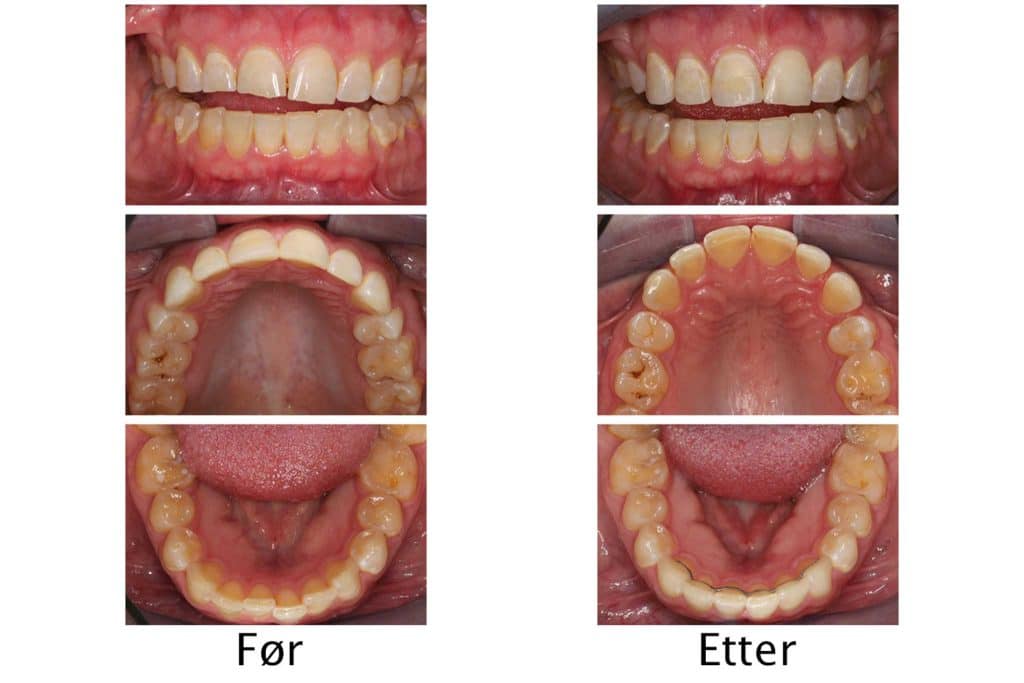Galleri: Hos Kolbotn Tannklinikk behandles tenner med Invisalign og fyllingsmateriale for estetisk resultat – Kolbotn, Follo, Myrvoll og Nordstrand.