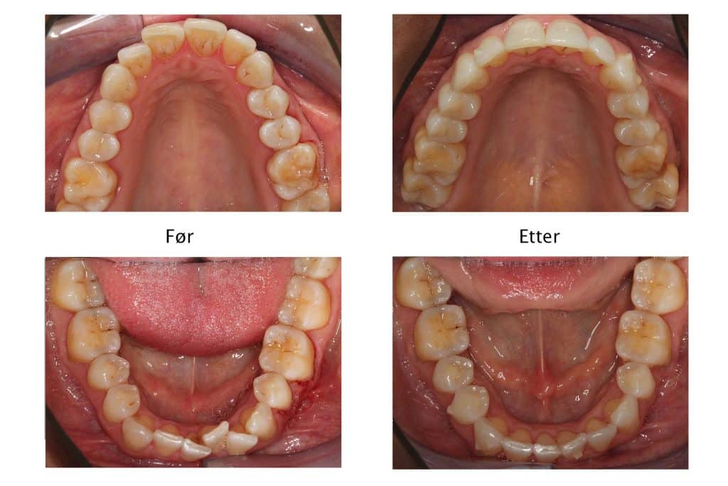 Galleri: Ved Kolbotn Tannklinikk rettes tennene med Invisalign – pasienter i Kolbotn, Vinterbro, Oppegård og Holmlia.