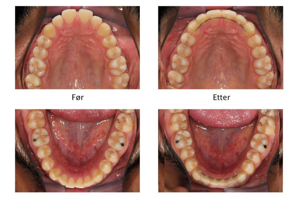 Galleri: Tannleger på Kolbotn Tannklinikk viser resultat med Invisalign og retainertråd – Kolbotn, Follo, Sofiemyr og Greverud.