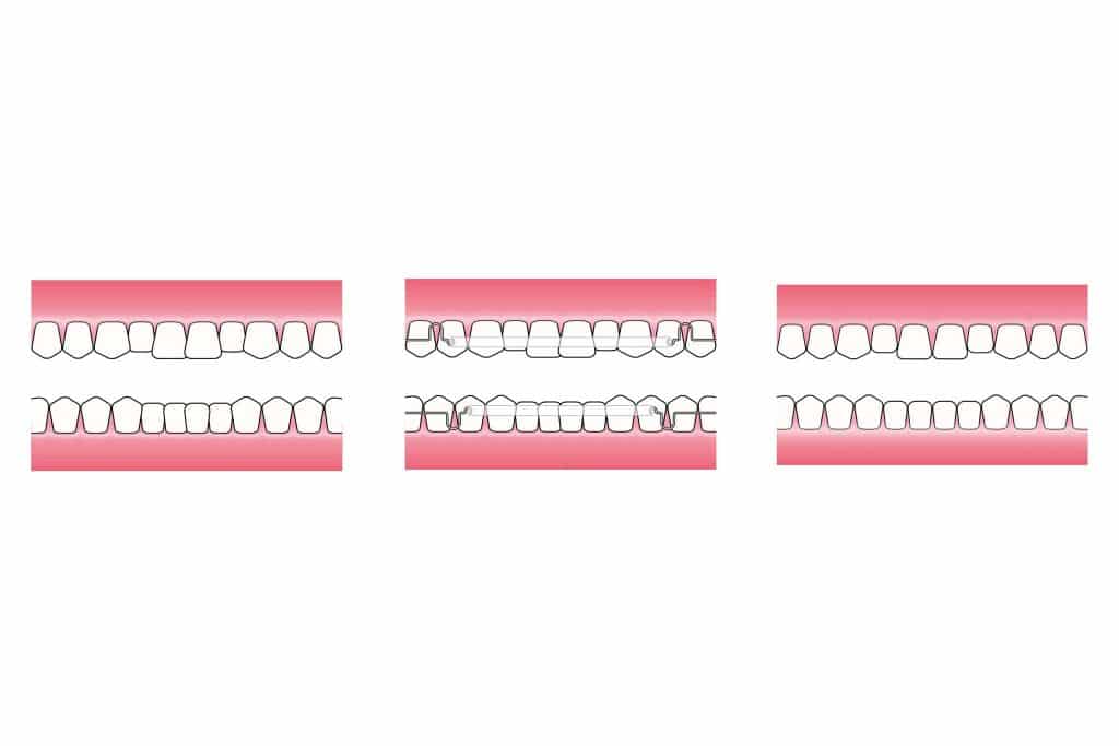 Hos Kolbotn Tannklinikk vises Inman Aligner-apparaturen som gir rask og effektiv tannforflytning – behandling i Kolbotn, Follo, Oppegård og Nordstrand.