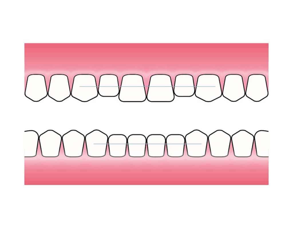 Hos Kolbotn Tannklinikk monteres retainertråd på baksiden av tennene for å sikre stabilitet etter korttidstannregulering – Kolbotn, Follo, Sofiemyr og Nordstrand.