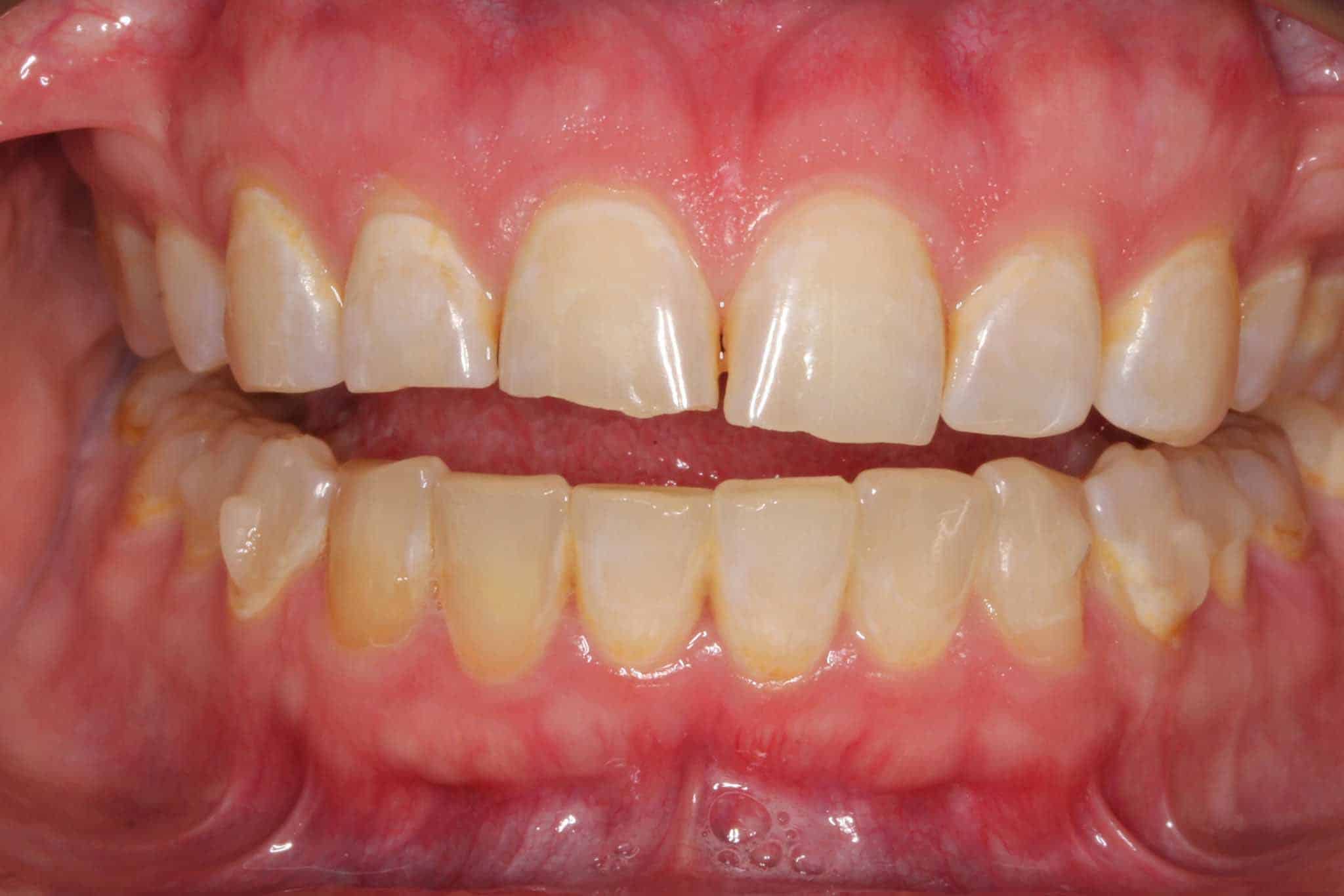 Før- og etterbilde: Tannleger på Kolbotn Tannklinikk viser resultat etter Invisalign og fyllinger – Kolbotn, Follo, Greverud og Hauketo.