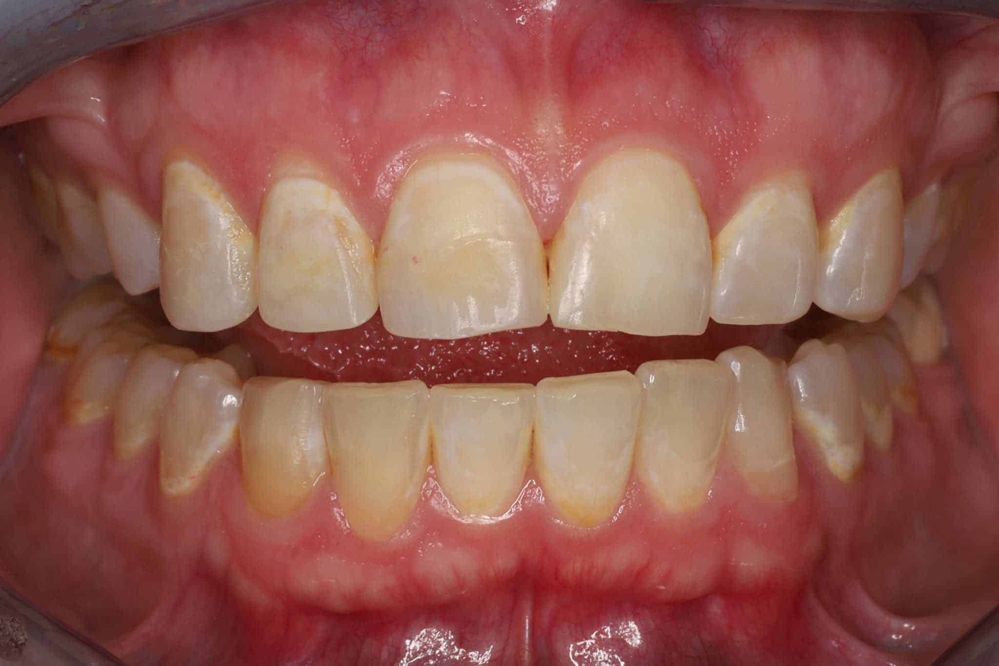 Før- og etterbilde: Tannleger på Kolbotn Tannklinikk viser resultat etter Invisalign og fyllinger – Kolbotn, Follo, Greverud og Hauketo.