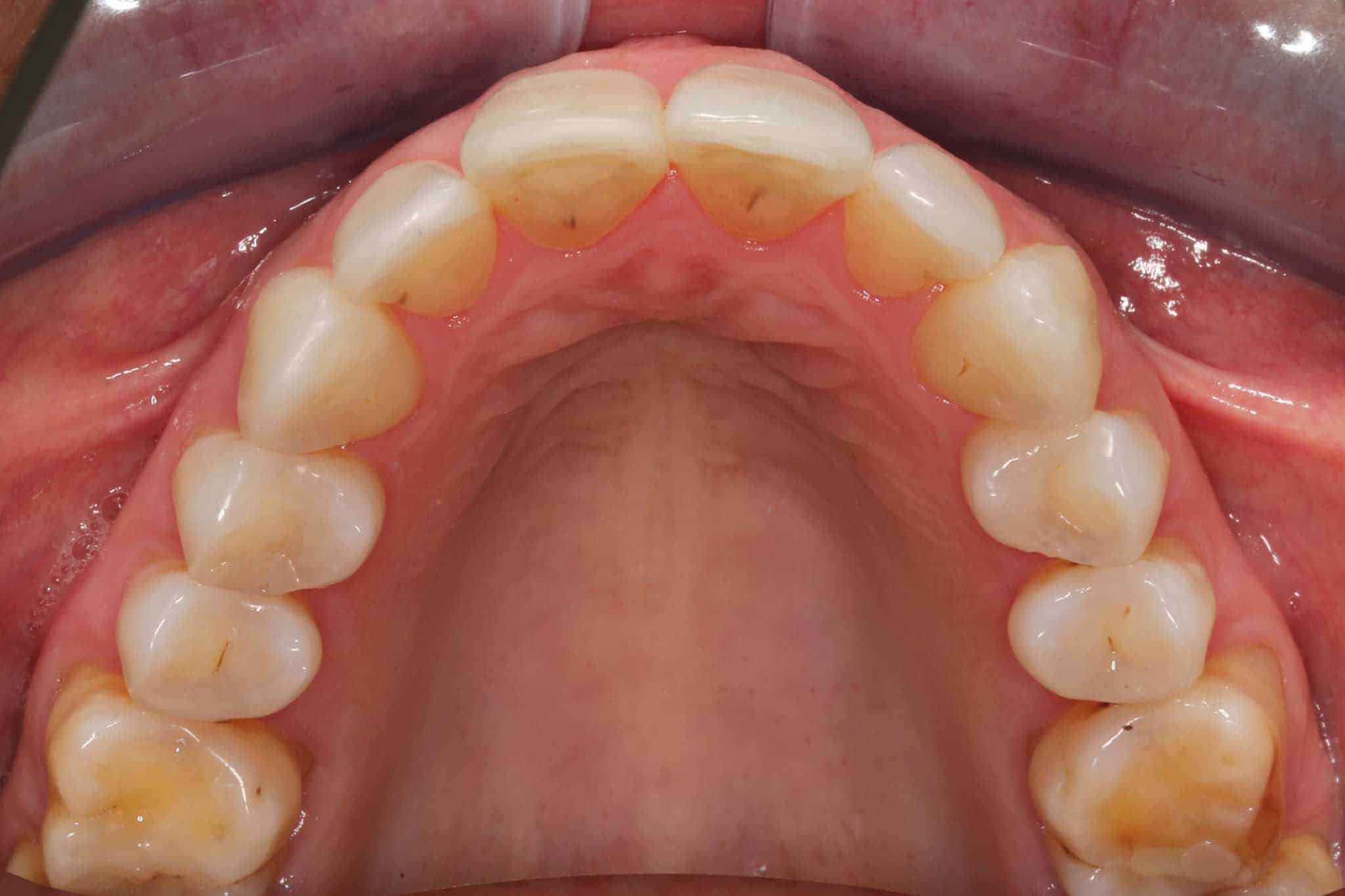 Før- og etterbilde: Tannlegene på Kolbotn Tannklinikk monterer retainertråd for å sikre varig resultat etter Invisalign – Kolbotn, Vinterbro, Follo og Myrvoll.