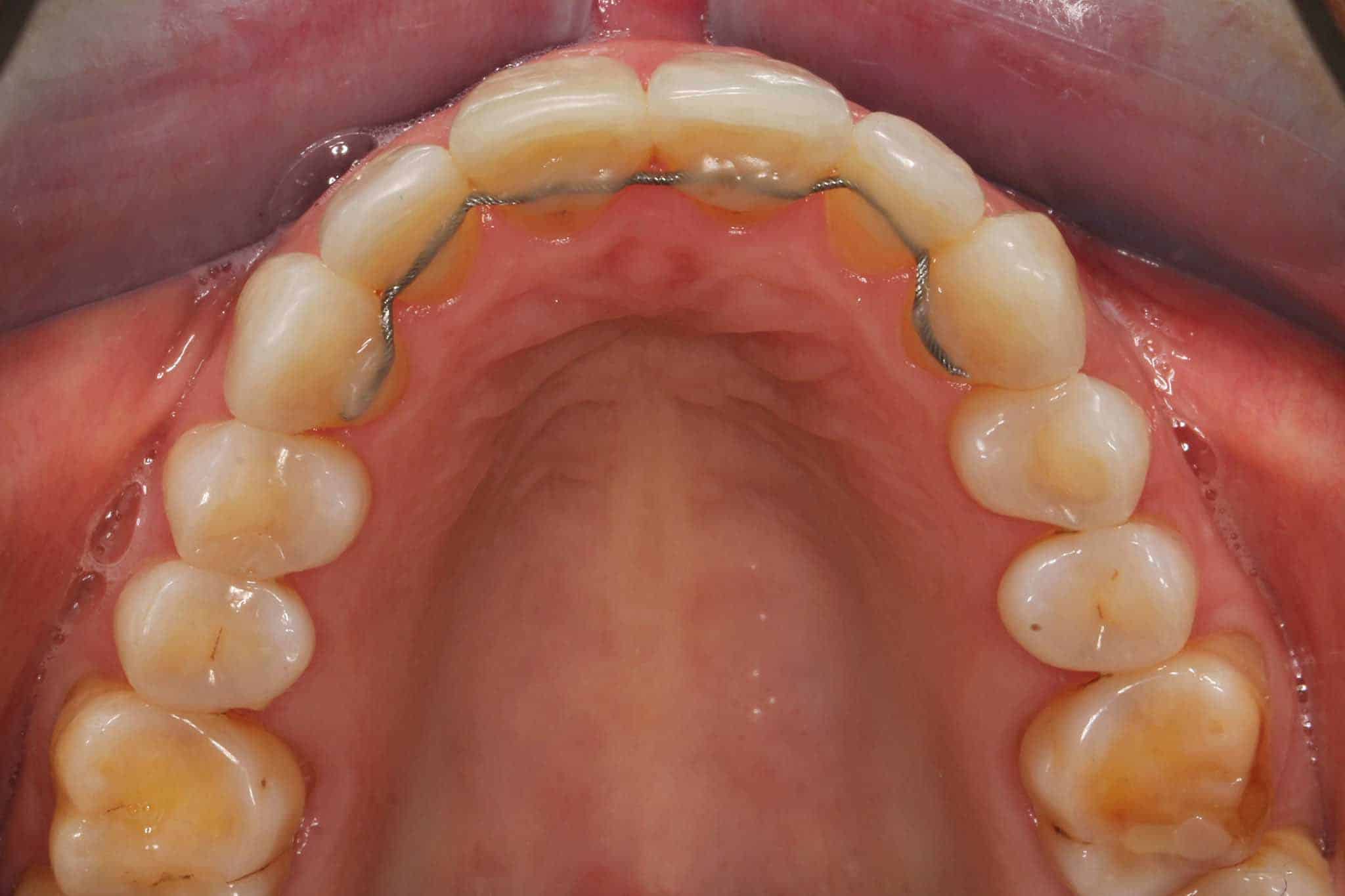 Før- og etterbilde: Tannlegene på Kolbotn Tannklinikk monterer retainertråd for å sikre varig resultat etter Invisalign – Kolbotn, Vinterbro, Follo og Myrvoll.