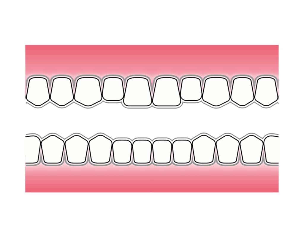 Ved Kolbotn Tannklinikk brukes retainerskinne for å stabilisere tennene etter korttidstannregulering – Kolbotn, Oppegård, Greverud og Nordstrand.