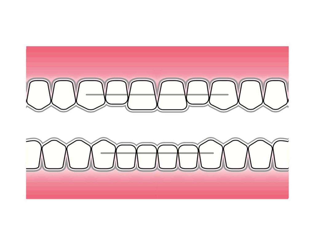 Illustrasjonen viser tannsett med retainertråd og retainerskinne for maksimal forankring. Alt-tekst: Ved Kolbotn Tannklinikk vises retainertråd og retainerskinne brukt for å sikre tennenes nye posisjon etter korttidstannregulering – Kolbotn, Vinterbro, Follo og Holmlia.