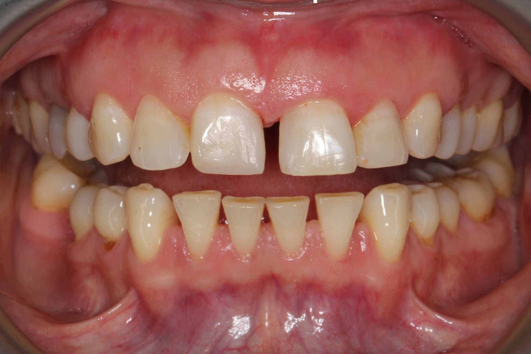 Før- og etterbilde: Hos Kolbotn Tannklinikk rettes tennene med Invisalign og bygges opp med estetisk fyllingsmateriale – Kolbotn, Follo, Sofiemyr og Nordstrand.