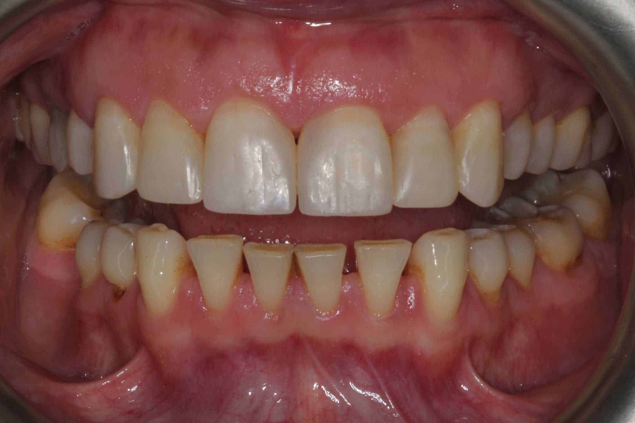 Før- og etterbilde: Hos Kolbotn Tannklinikk rettes tennene med Invisalign og bygges opp med estetisk fyllingsmateriale – Kolbotn, Follo, Sofiemyr og Nordstrand.