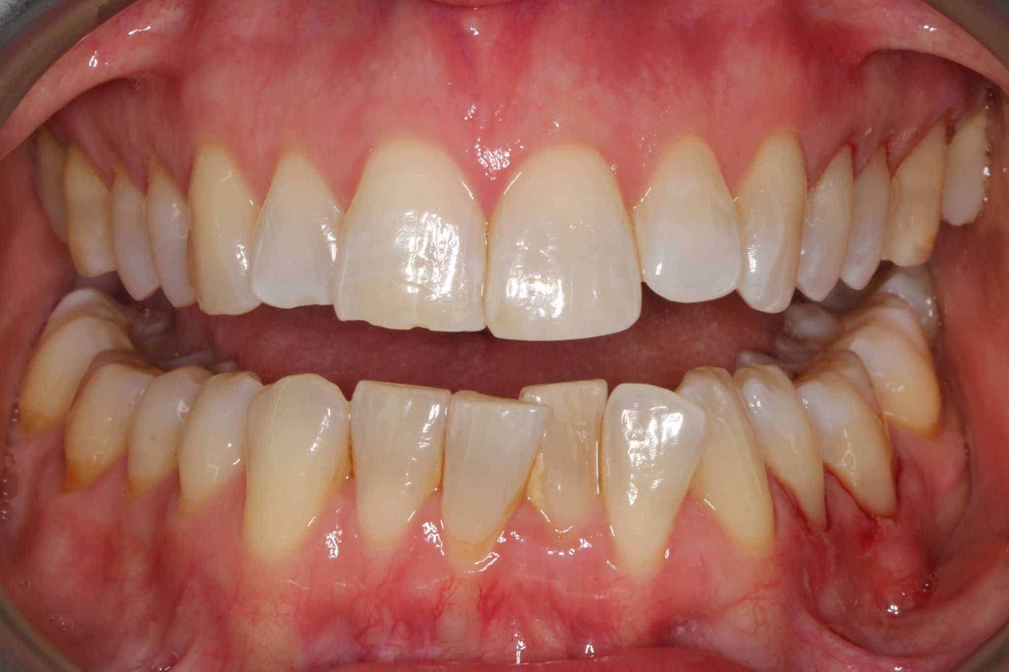 Før- og etterbilde: Tannlegene på Kolbotn Tannklinikk retter tennene med Invisalign – Kolbotn, Follo, Nordstrand og Greverud.