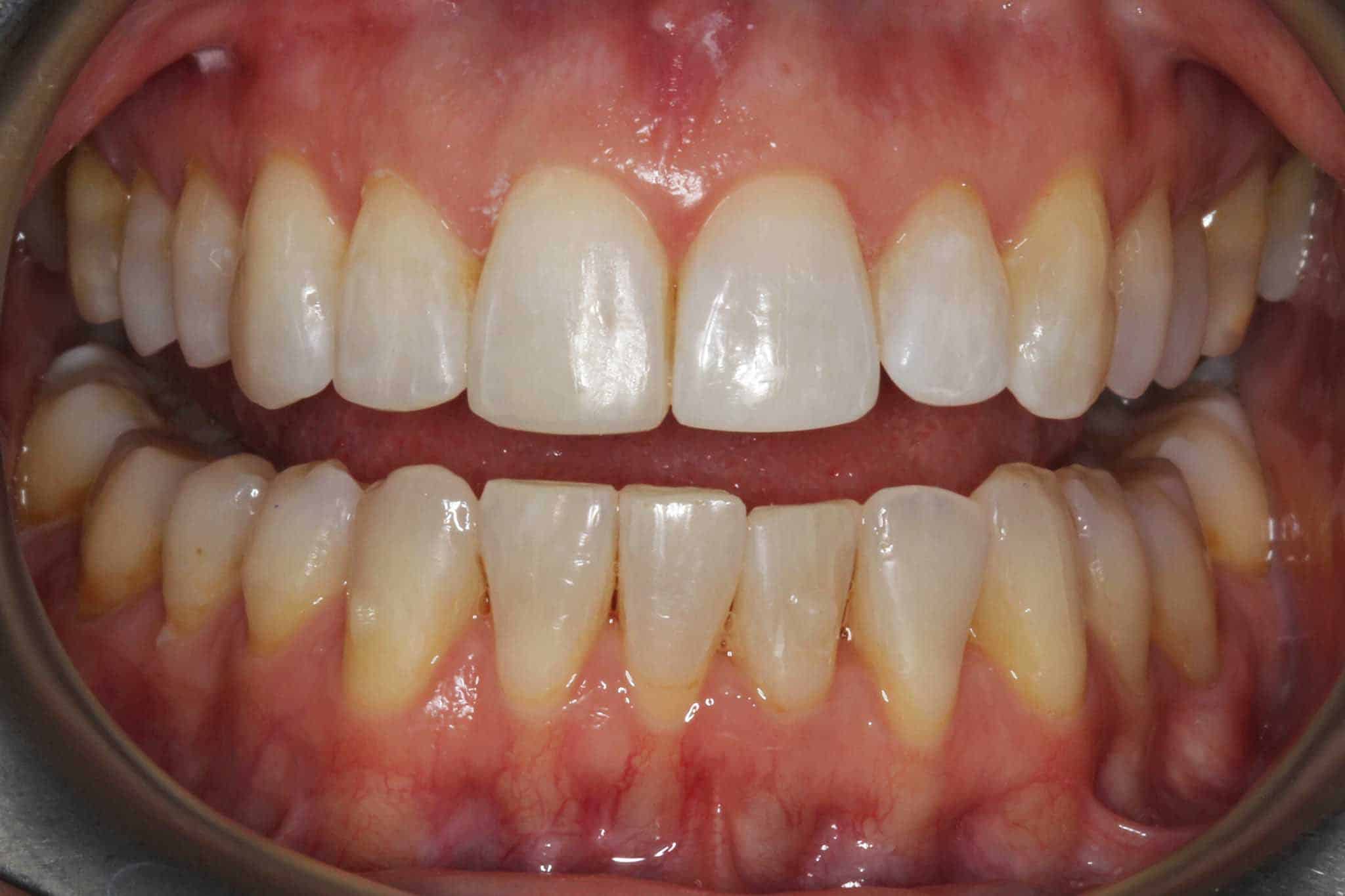 Før- og etterbilde: Ved Kolbotn Tannklinikk kombineres Invisalign og fyllinger for å forbedre fortenner – Kolbotn, Vinterbro, Oppegård og Holmlia.