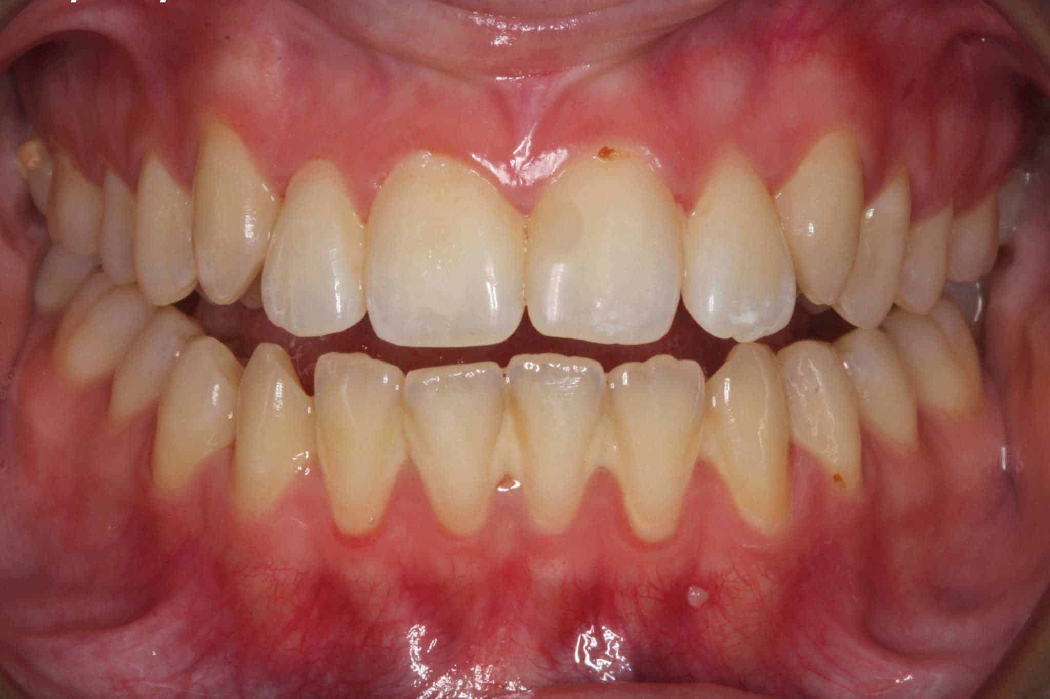 Før- og etterbilde: Hos Kolbotn Tannklinikk rettes overkjevens fortenner med Inman Aligner – pasienter i Kolbotn, Follo, Oppegård og Nordstrand.