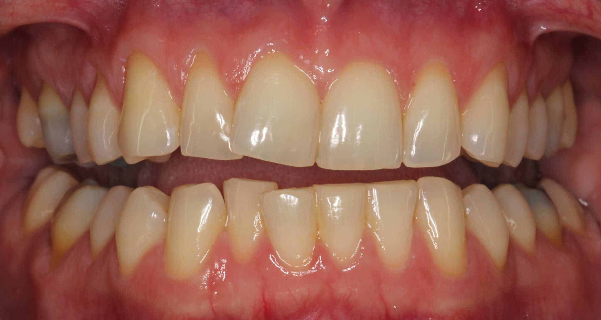 Før- og etterbilde: Hos Kolbotn Tannklinikk rettes overkjevens fortenner med Inman Aligner – pasienter i Kolbotn, Follo, Oppegård og Nordstrand.