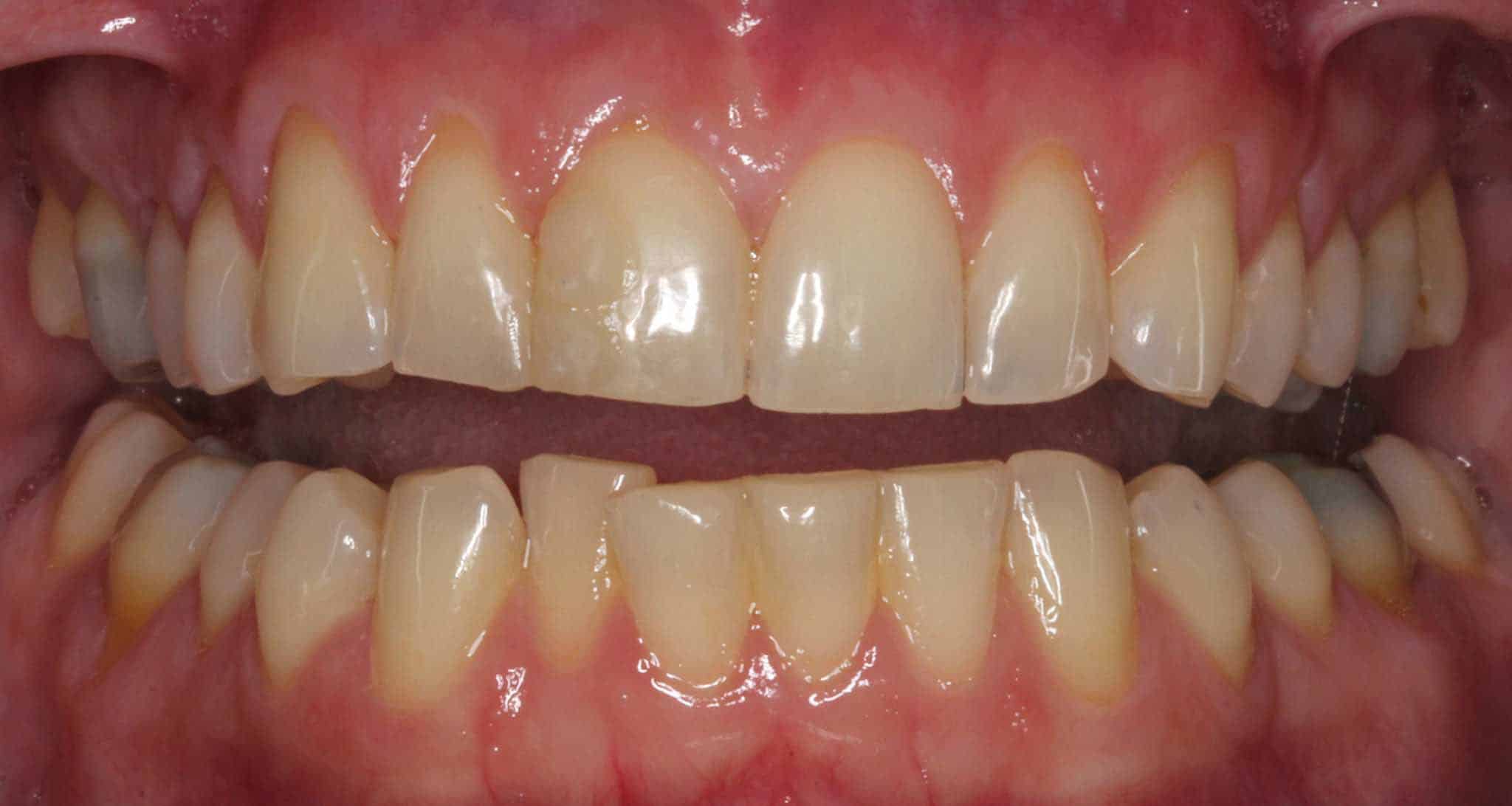 Før- og etterbilde: Hos Kolbotn Tannklinikk rettes overkjevens fortenner med Inman Aligner – pasienter i Kolbotn, Follo, Oppegård og Nordstrand.