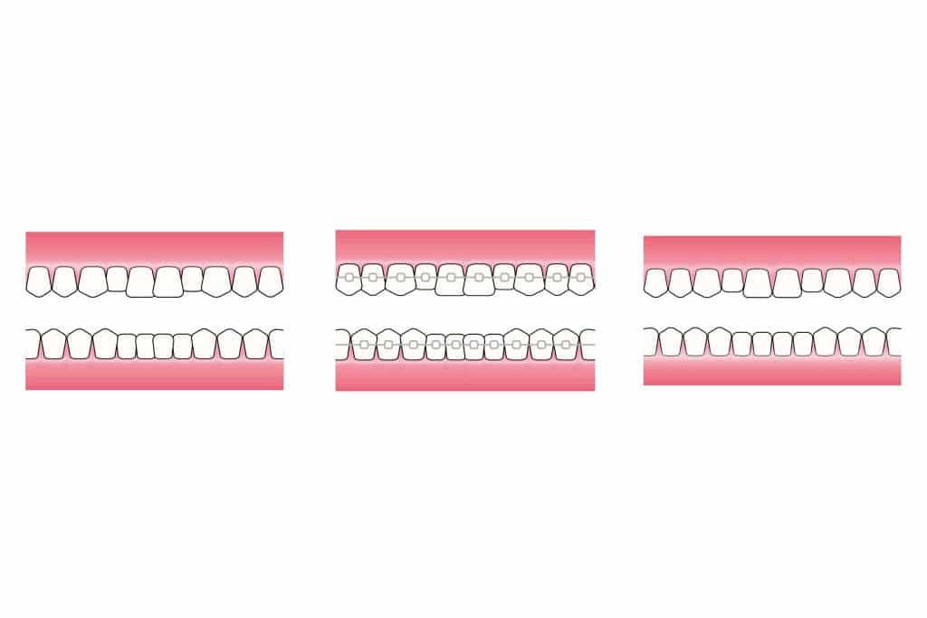 Hos Kolbotn Tannklinikk illustreres hvordan 6 Month Smiles med tannfargede klosser og tråd gir presis tannregulering – pasienter i Kolbotn, Follo, Vinterbro og Oppegård.