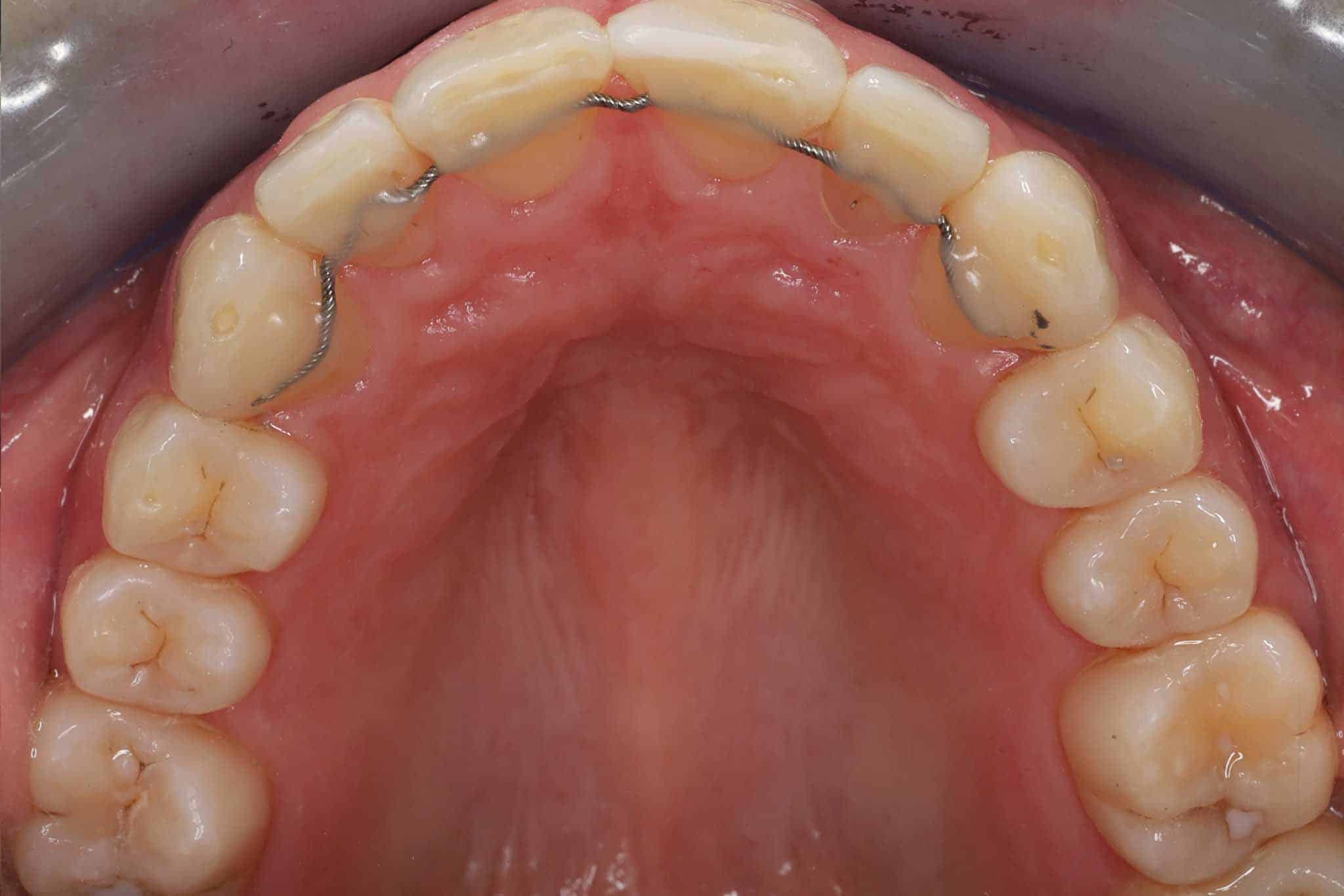 Før- og etterbilde: Tannlegene ved Kolbotn Tannklinikk monterer retainertråd på overkjeven – pasienter i Kolbotn, Follo, Vinterbro og Sofiemyr.