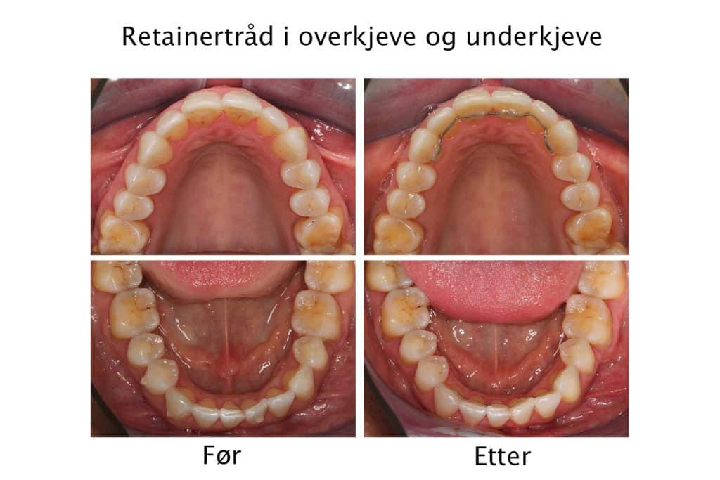 Galleri: Hos Kolbotn Tannklinikk sikres tenner etter regulering med retainertråd – Kolbotn, Follo, Greverud og Myrvoll.