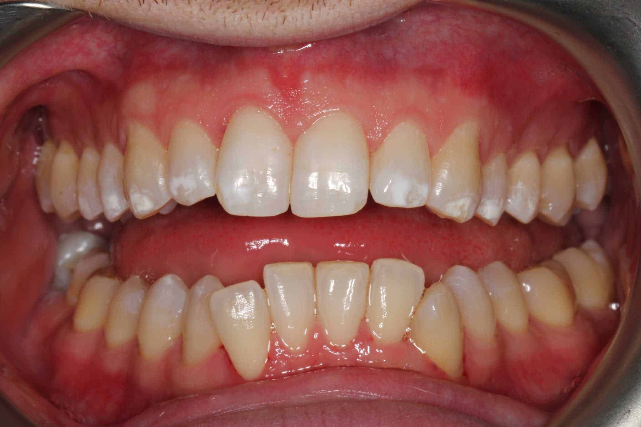 Før- og etterbilde: Hos Kolbotn Tannklinikk fjernet tannlegene belegg og misfarging – pasient fra Kolbotn, Follo og Vinterbro.